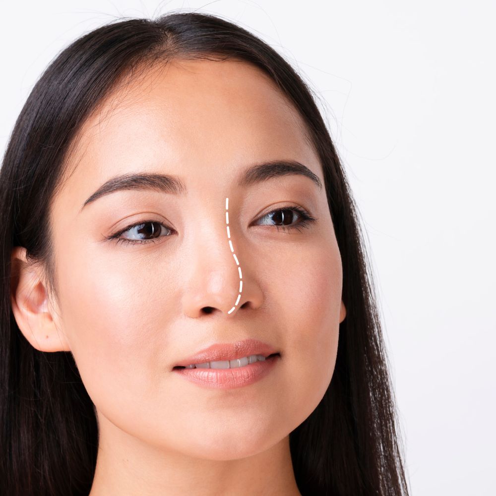 Rhinoplasty