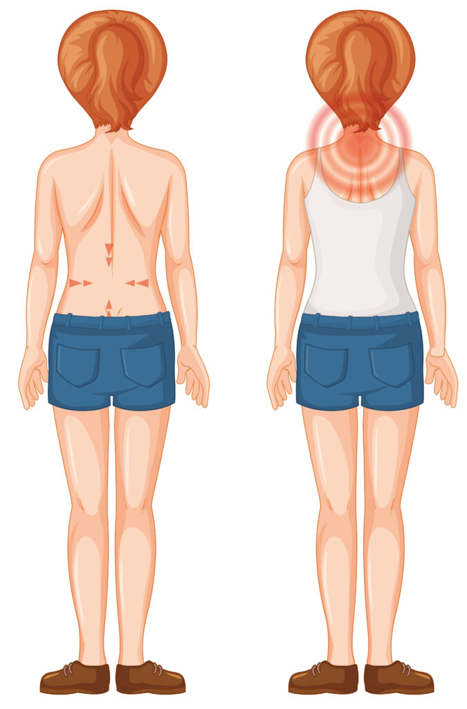 Back Liposuction Scars