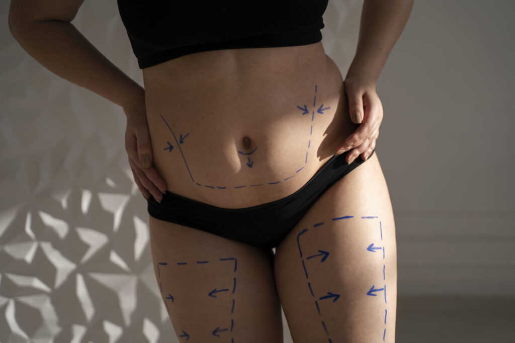 Inner Thigh Liposuction Scars