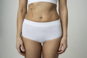 Mini Tummy Tuck with Liposuction in Korea