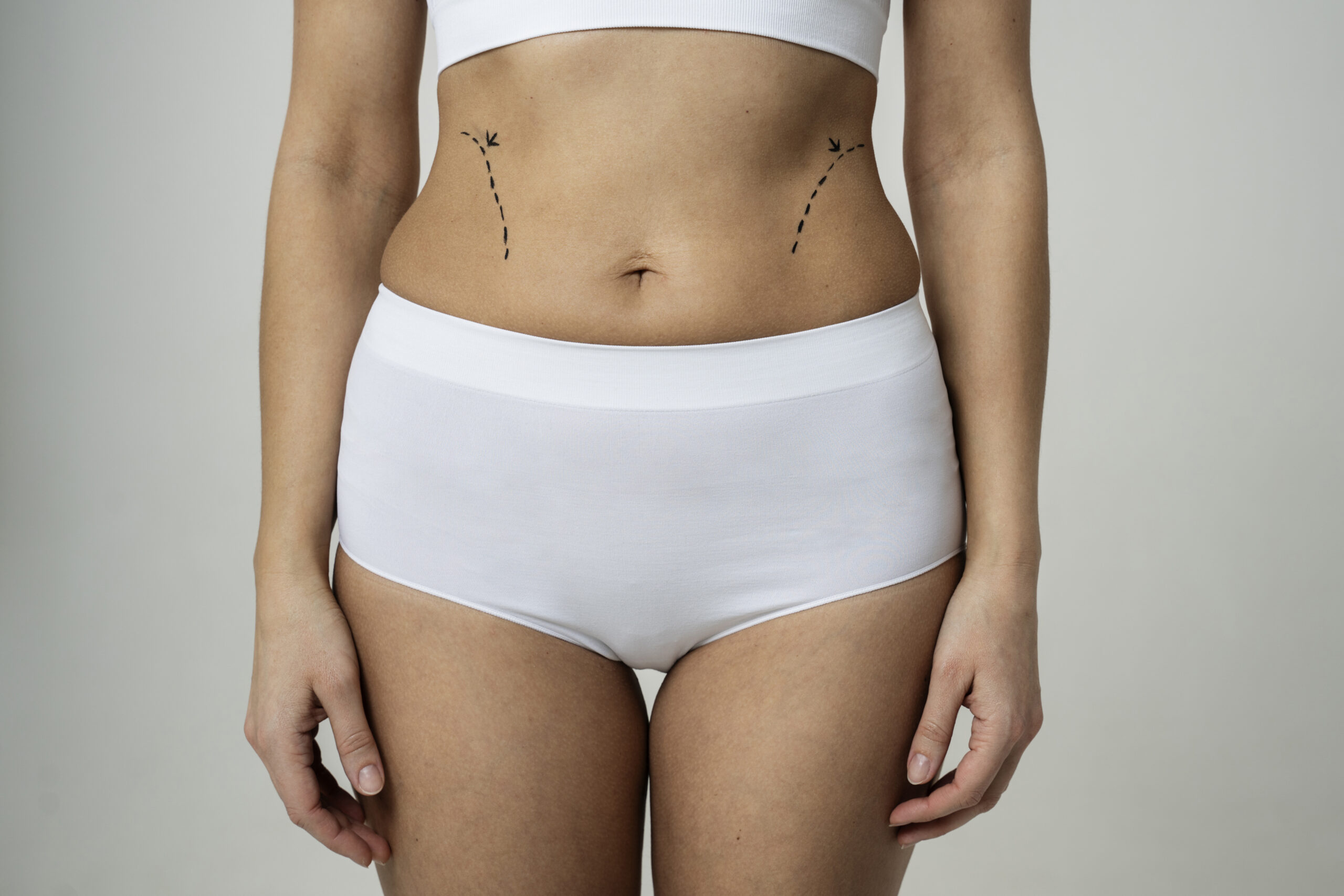 Mini Tummy Tuck with Liposuction in Korea