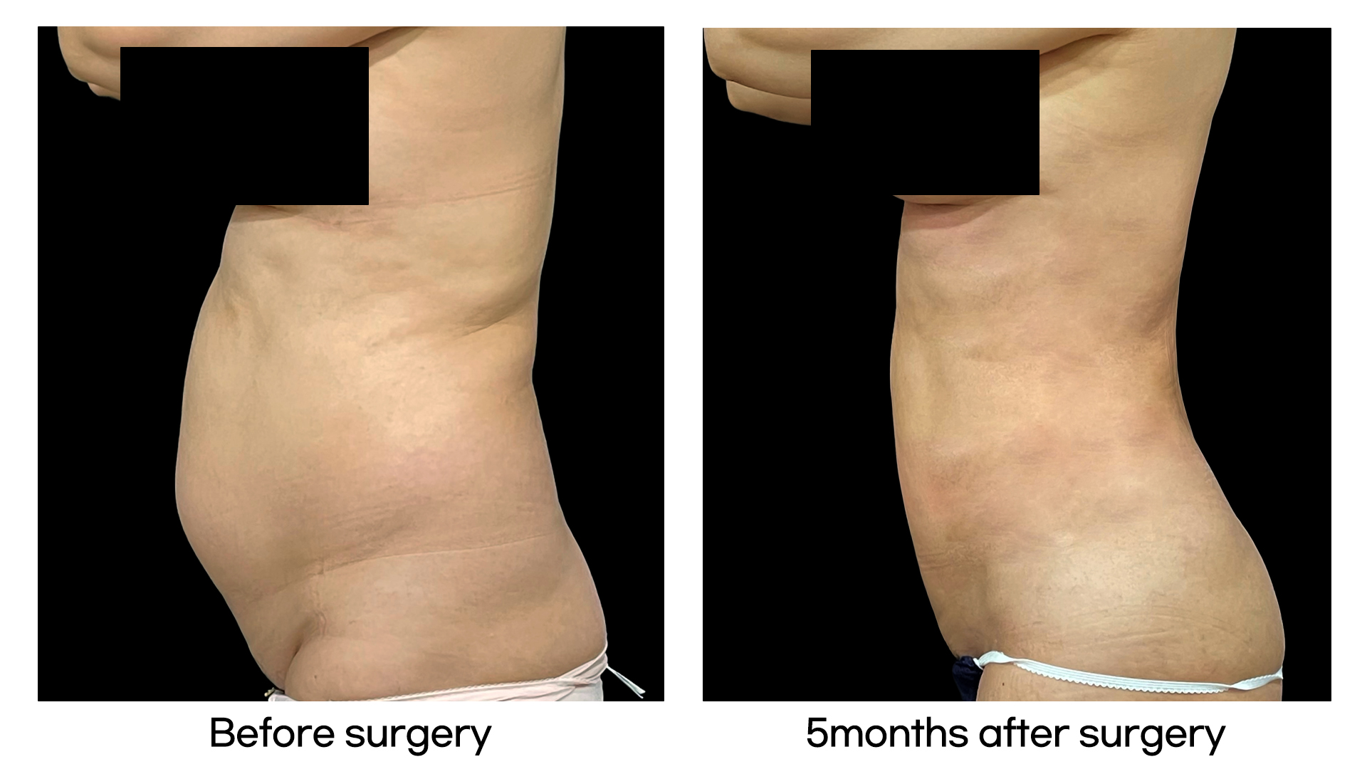 Meet Our Patients 53 5D Liposculpture in South Korea