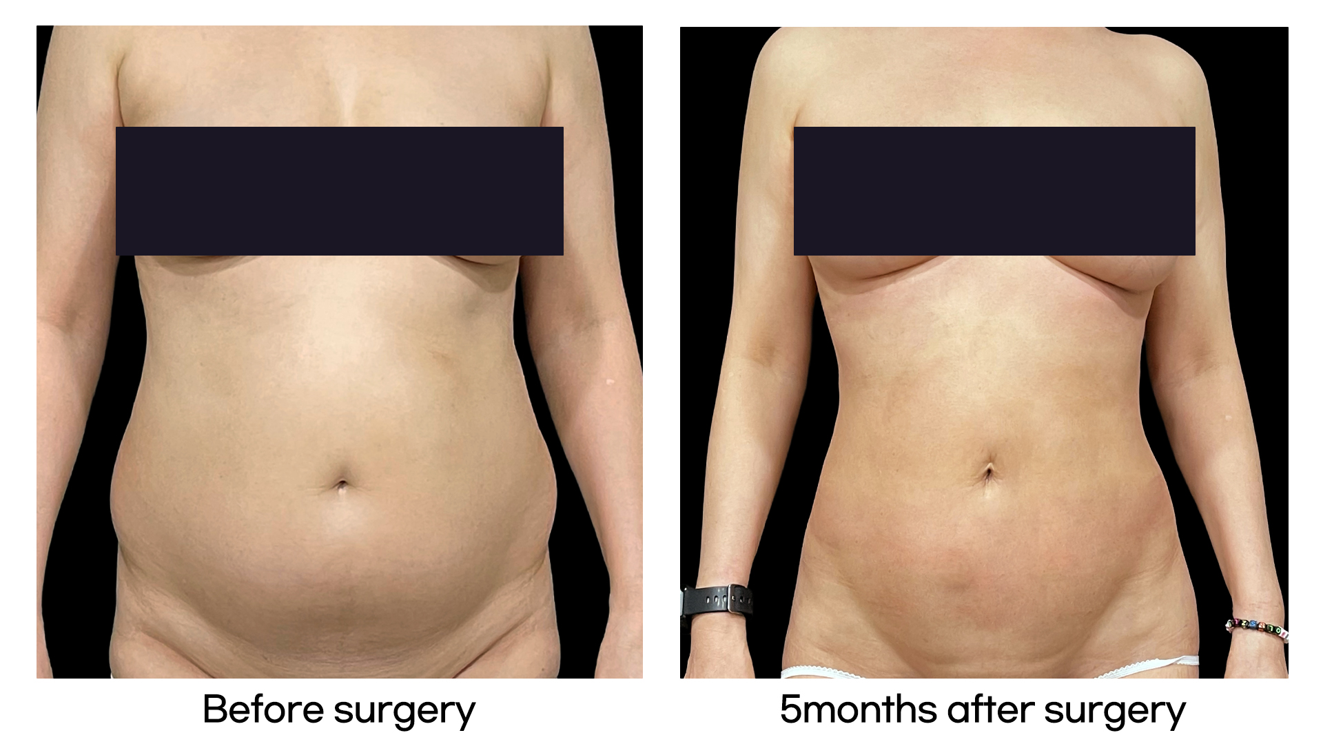 Meet Our Patients 65 5D Liposculpture in South Korea(1)