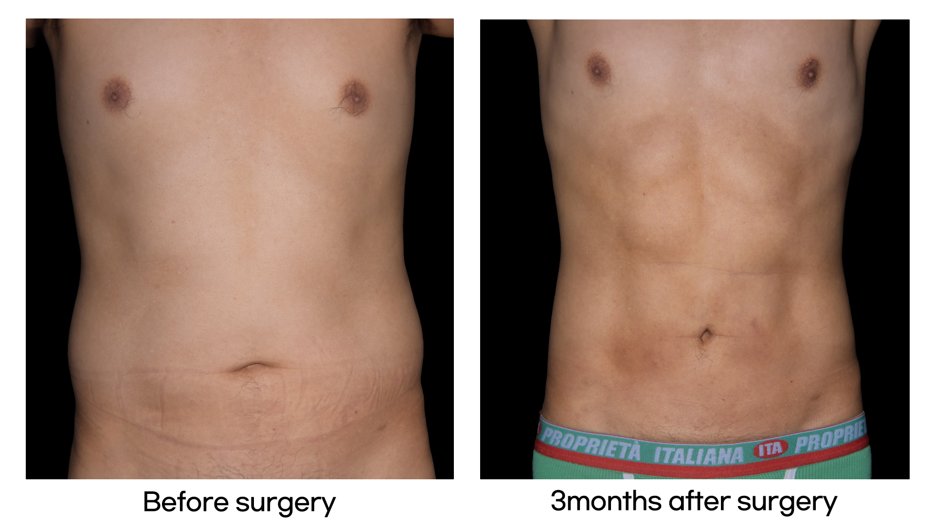 Meet Our Patients 34 Body Contouring treatments in Korea