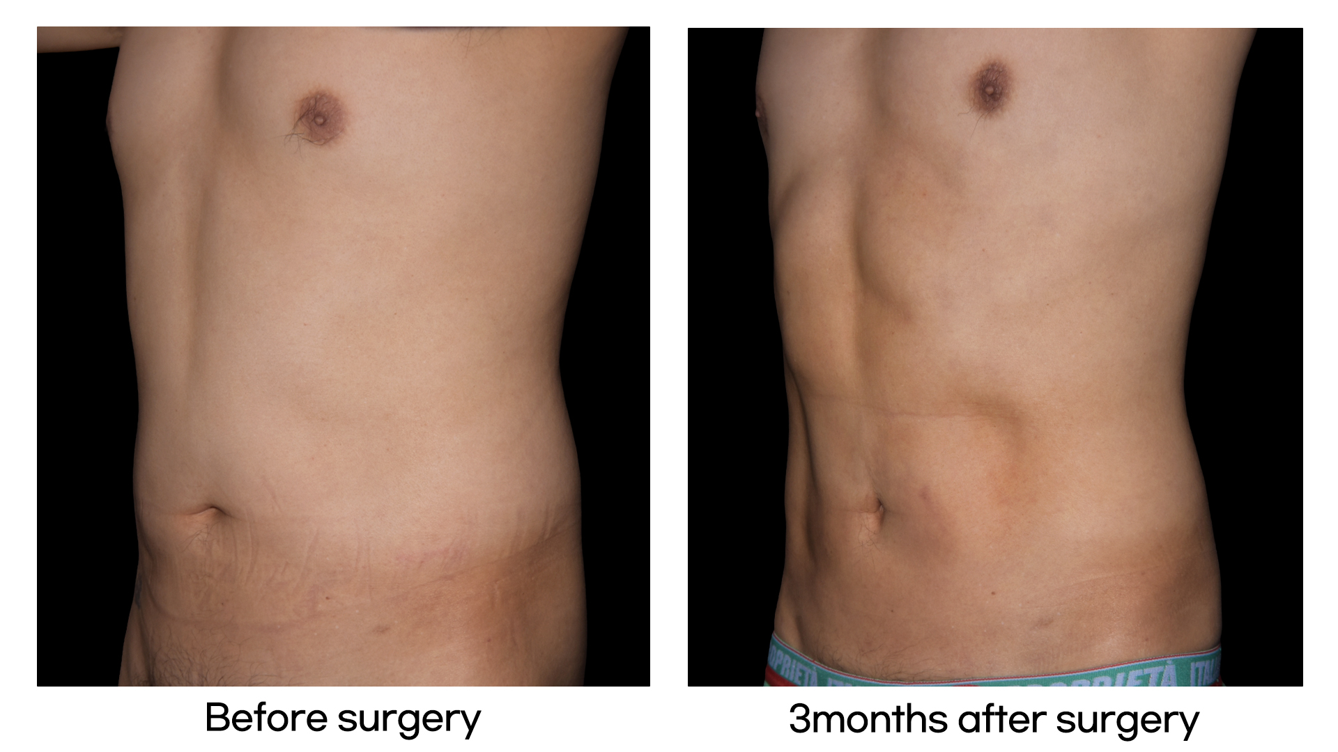 Meet Our Patients 32 Body Contouring treatments in Korea