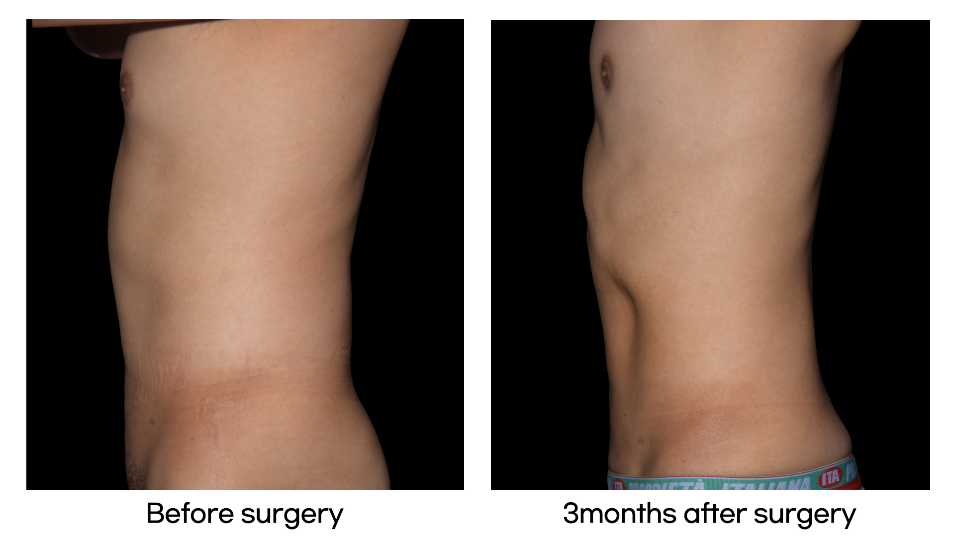 Meet Our Patients 33 Body Contouring treatments in Korea