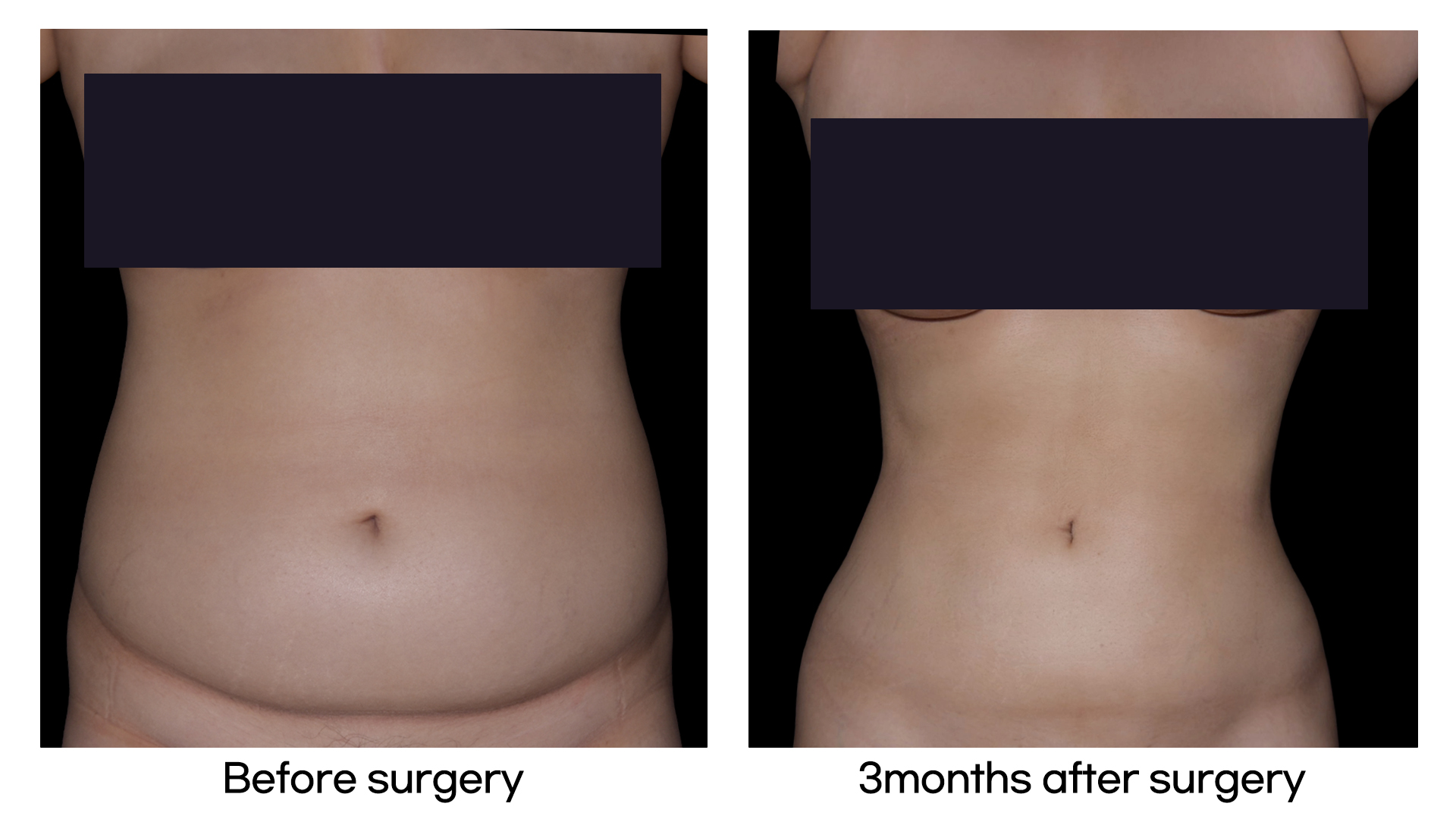 Meet Our Patients 39 Brazilian Hip Up in South Korea