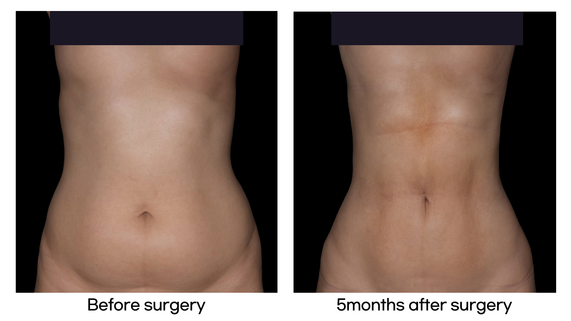 Meet Our Patients 42 Brazilian Hip Up in South Korea