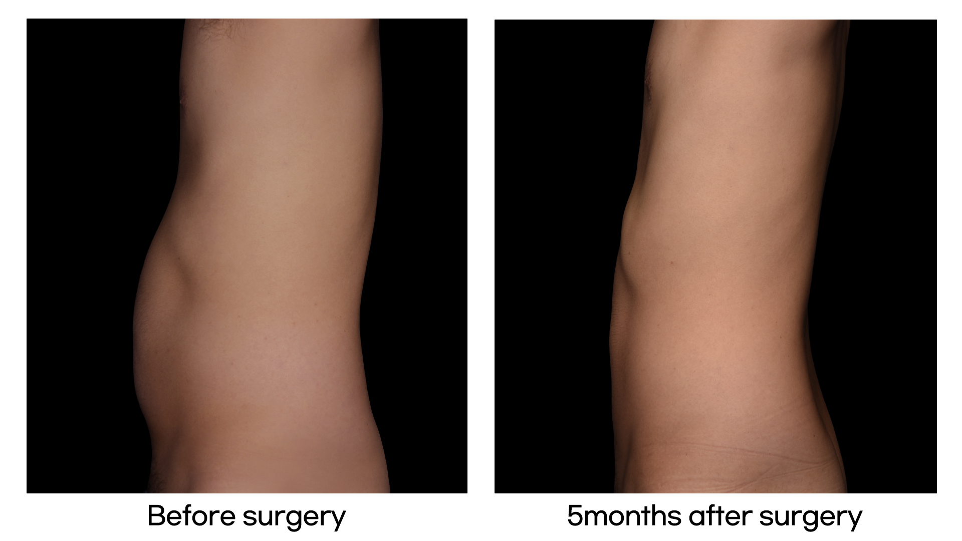 Meet Our Patients 37 Brazilian Hip Up in South Korea