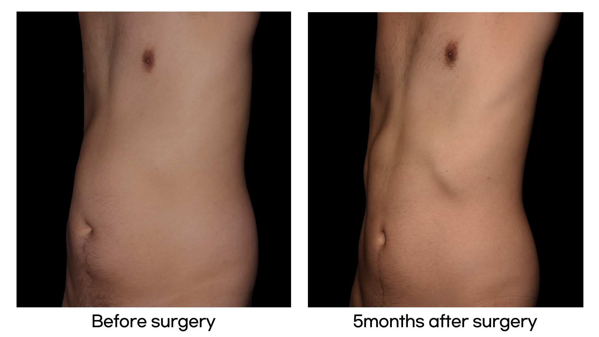 Meet Our Patients 35 Brazilian Hip Up in South Korea (Man