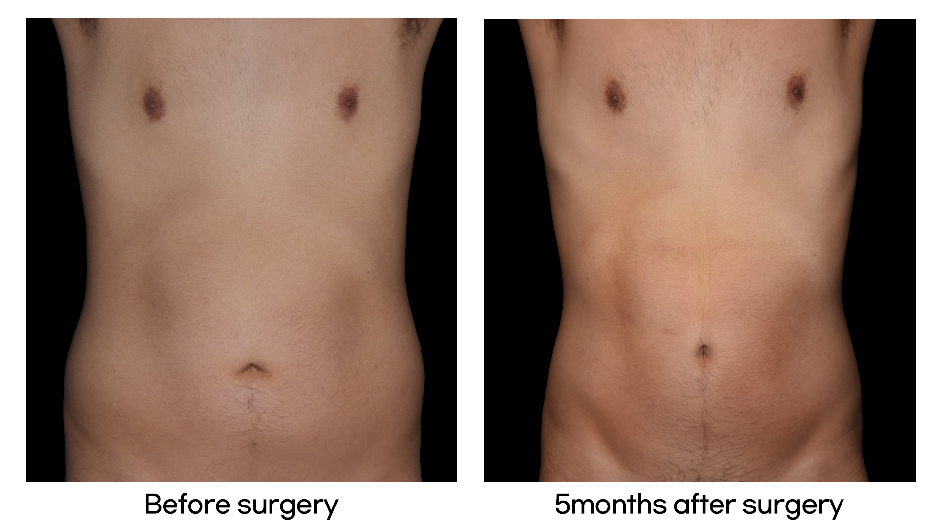 Meet Our Patients 36 Brazilian Hip Up in South Korea (Man