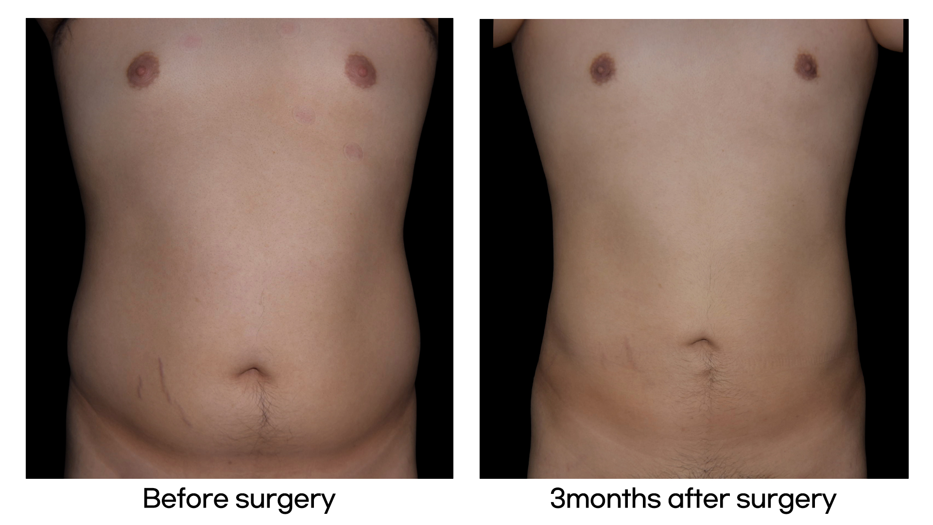 Meet Our Patients 76 Brazilian Hip Up in South Korea