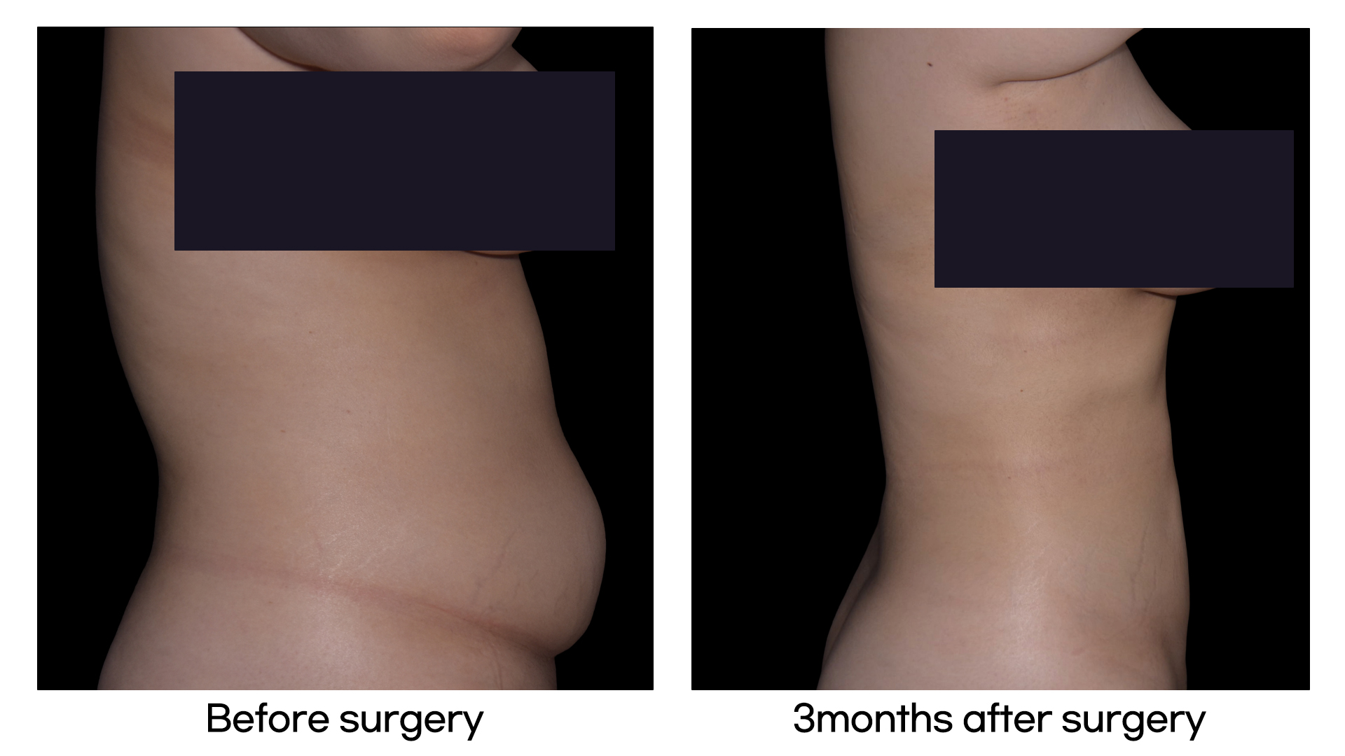 Meet Our Patients 73 Brazilian Hip Up in South Korea(5)