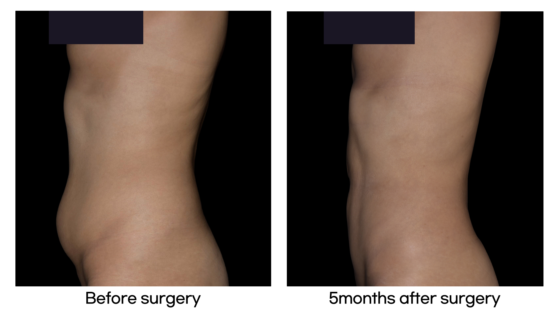 Meet Our Patients 74 Brazilian Hip Up in South Korea(6)