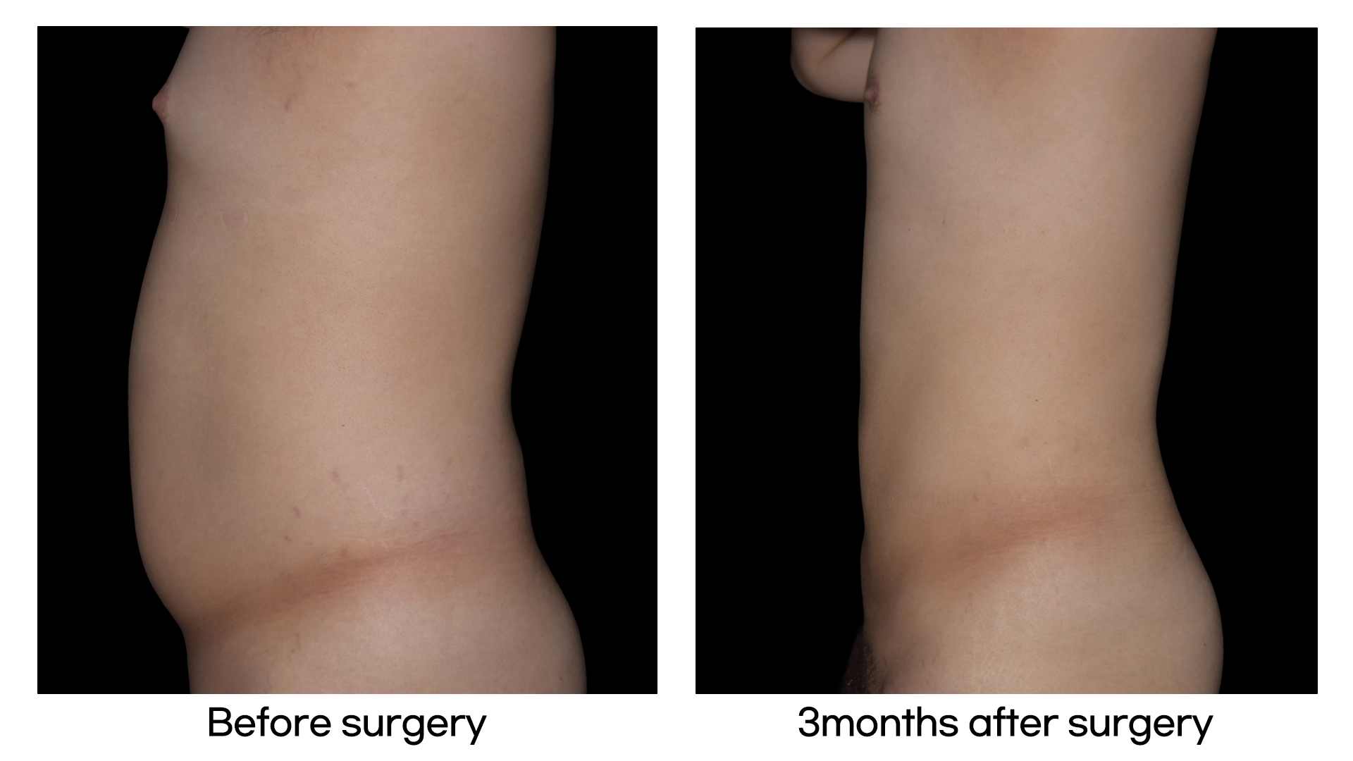 Meet Our Patients 75 Brazilian Hip Up in South Korea(7)