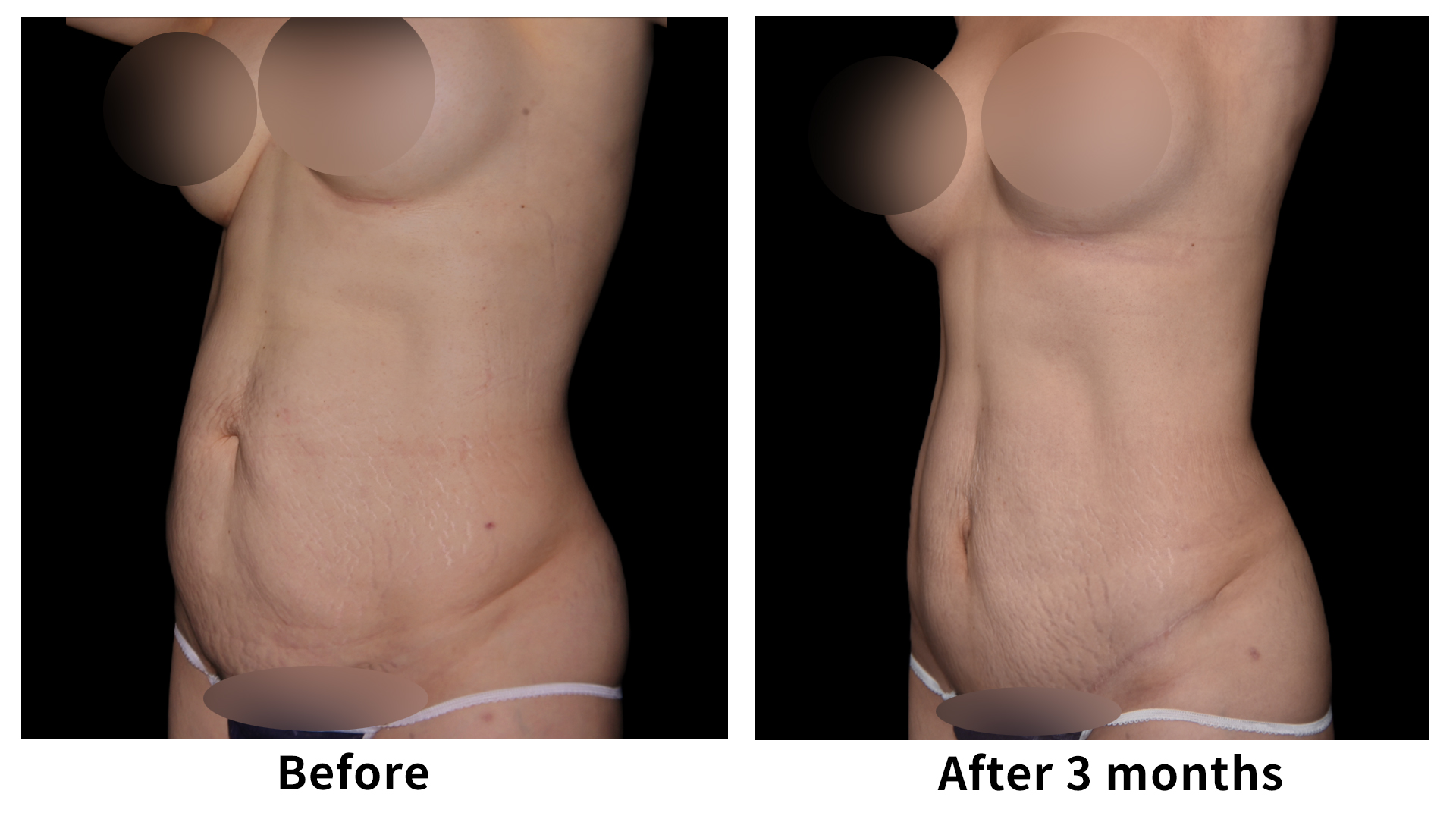 Meet Our Patients 90 Gynecomastia Surgery in South Korea