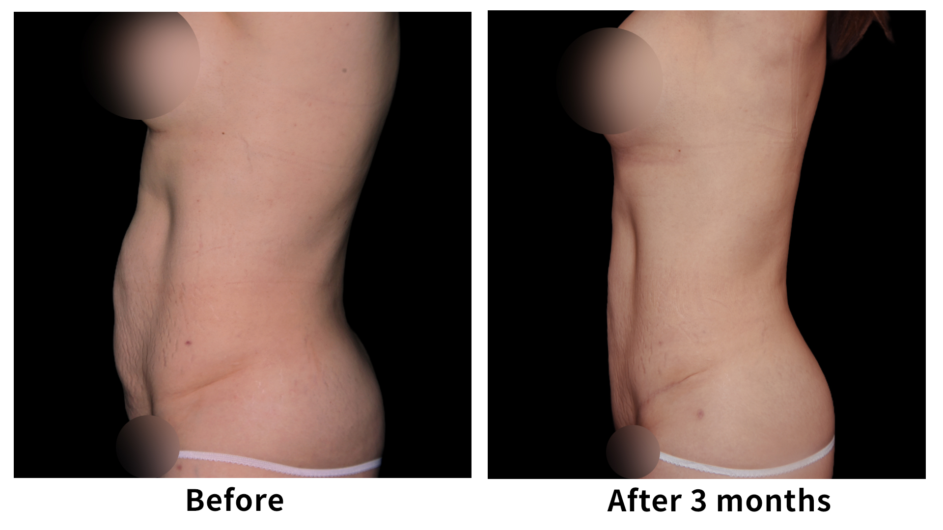 Meet Our Patients 86 Gynecomastia Surgery in South Korea(1)