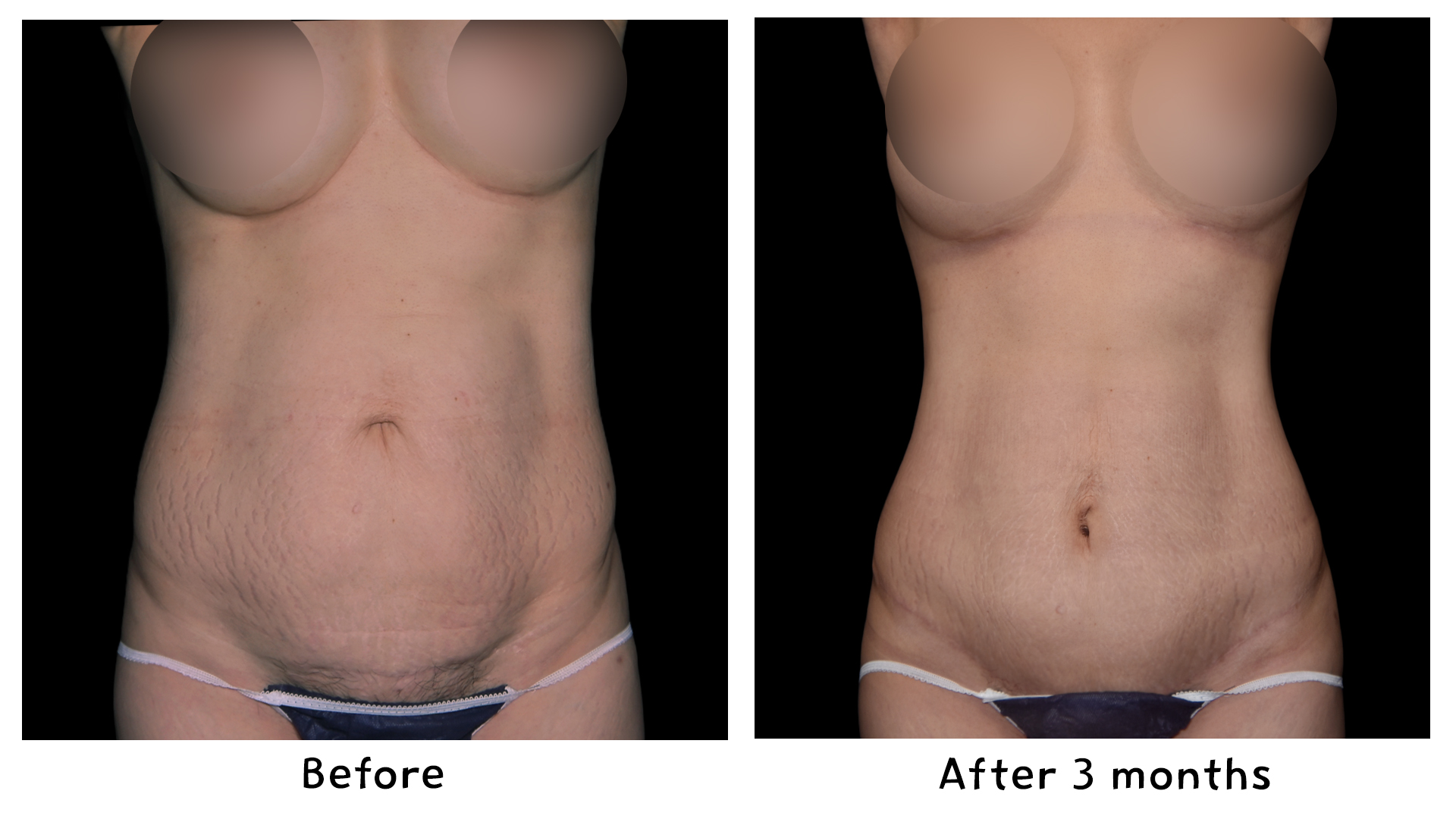 Meet Our Patients 87 Gynecomastia Surgery in South Korea(2)