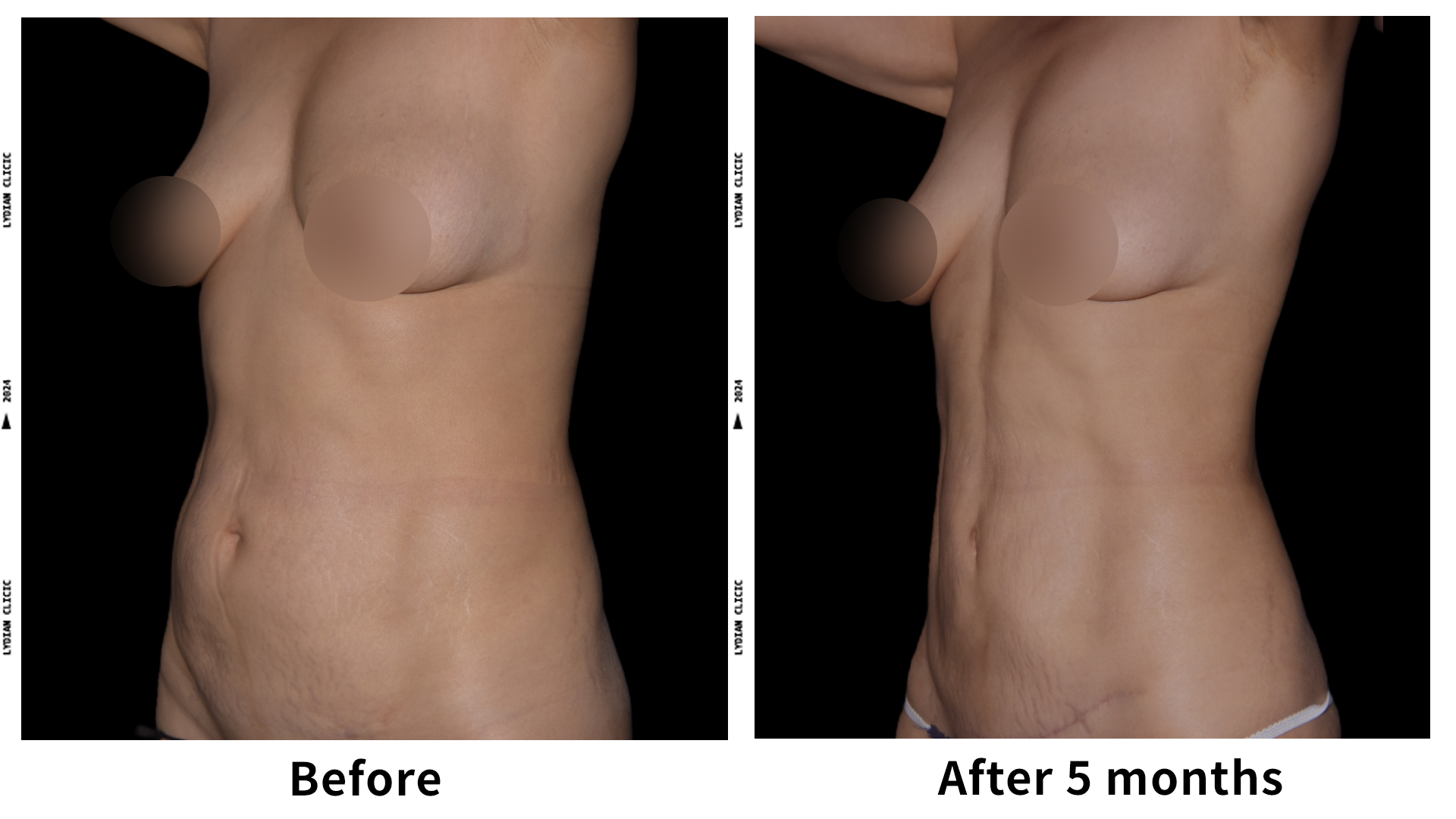 Meet Our Patients 88 Gynecomastia Surgery in South Korea(2)