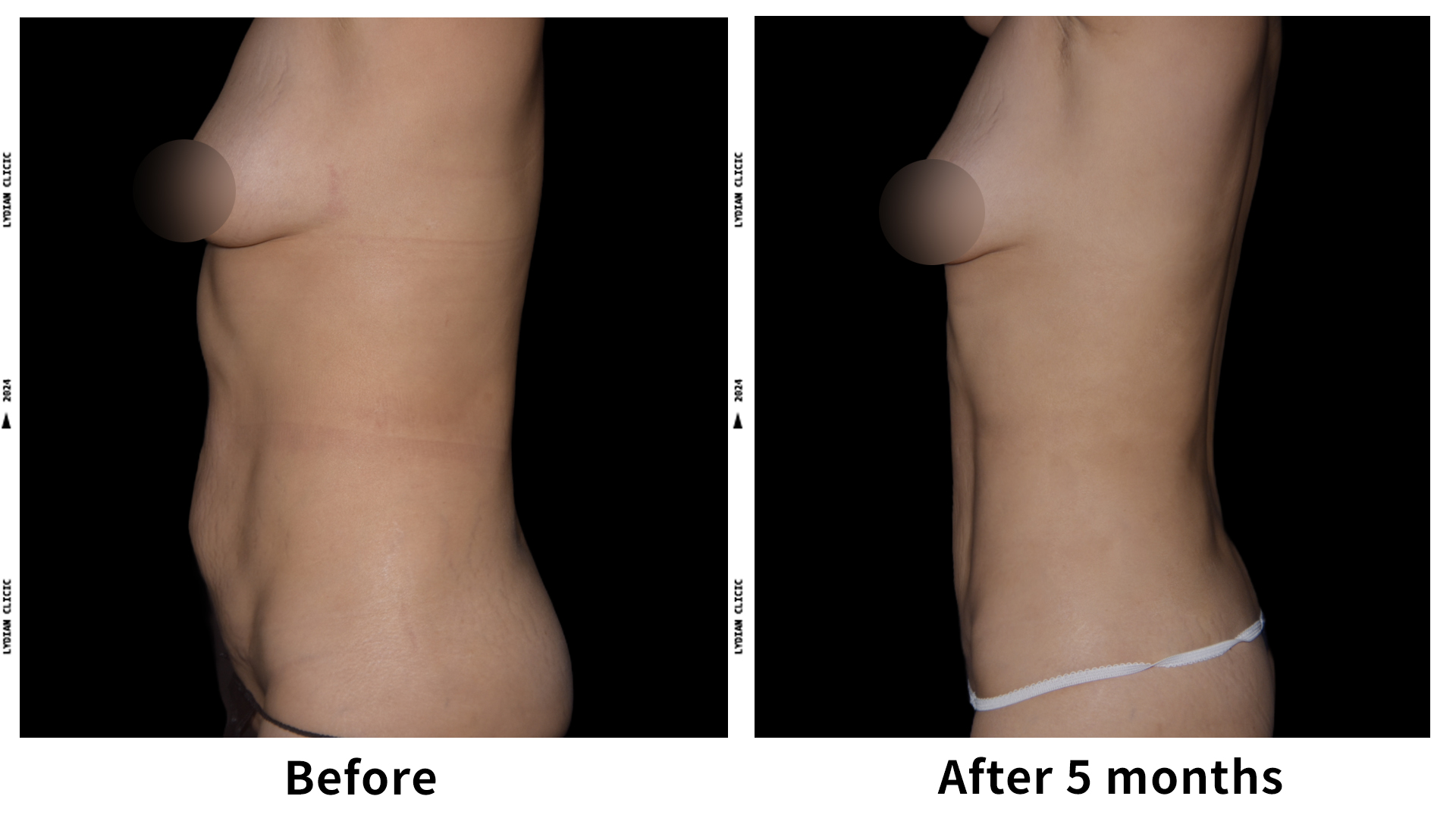 Meet Our Patients 89 Gynecomastia Surgery in South Korea(4)