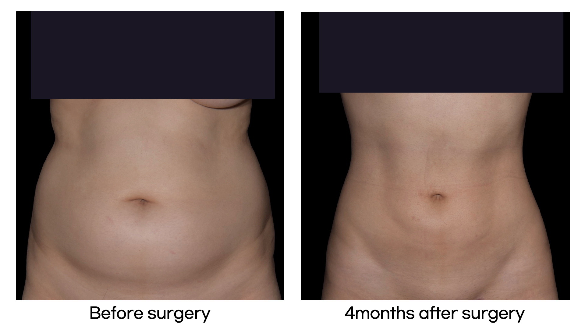Meet Our Patients 52 Liposuction in Korea