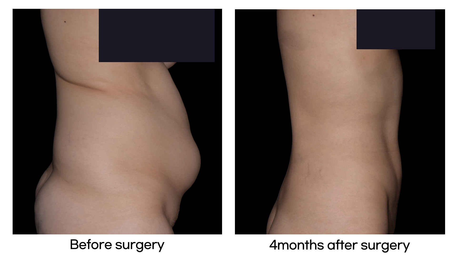 Meet Our Patients 50 Liposuction in Korea