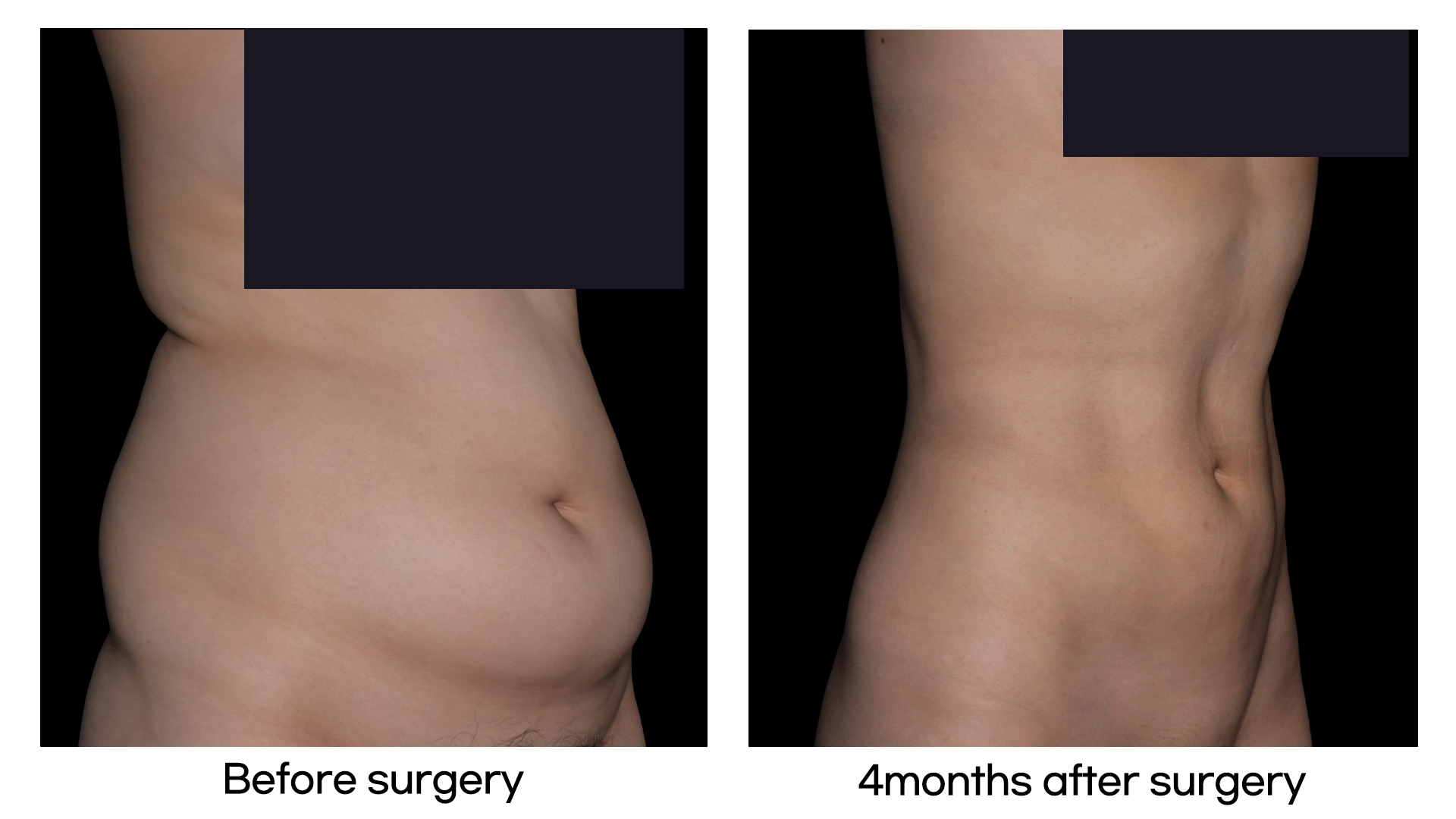Meet Our Patients 51 Liposuction in Korea