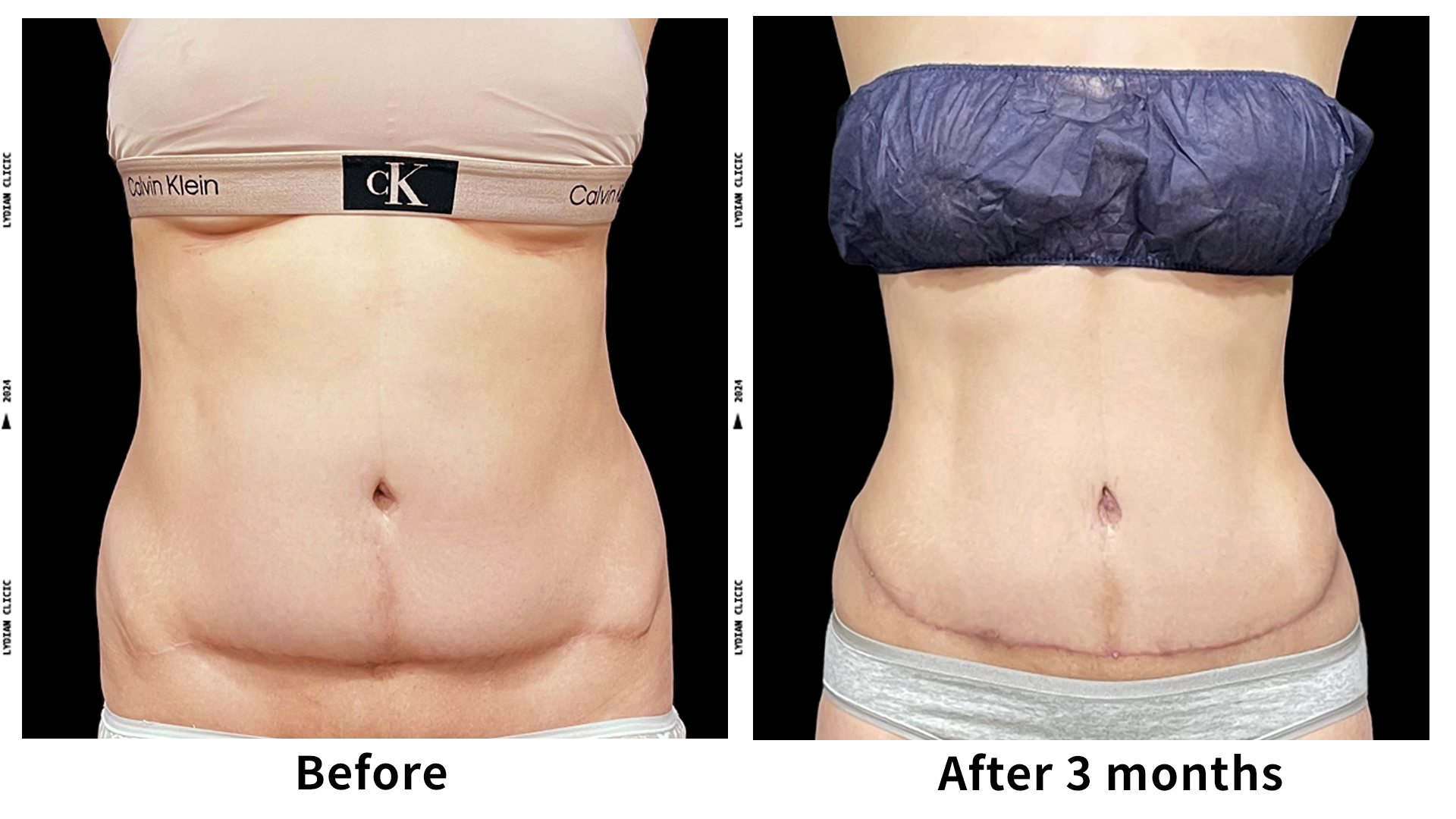 Meet Our Patients 57 Liposuction in South Korea