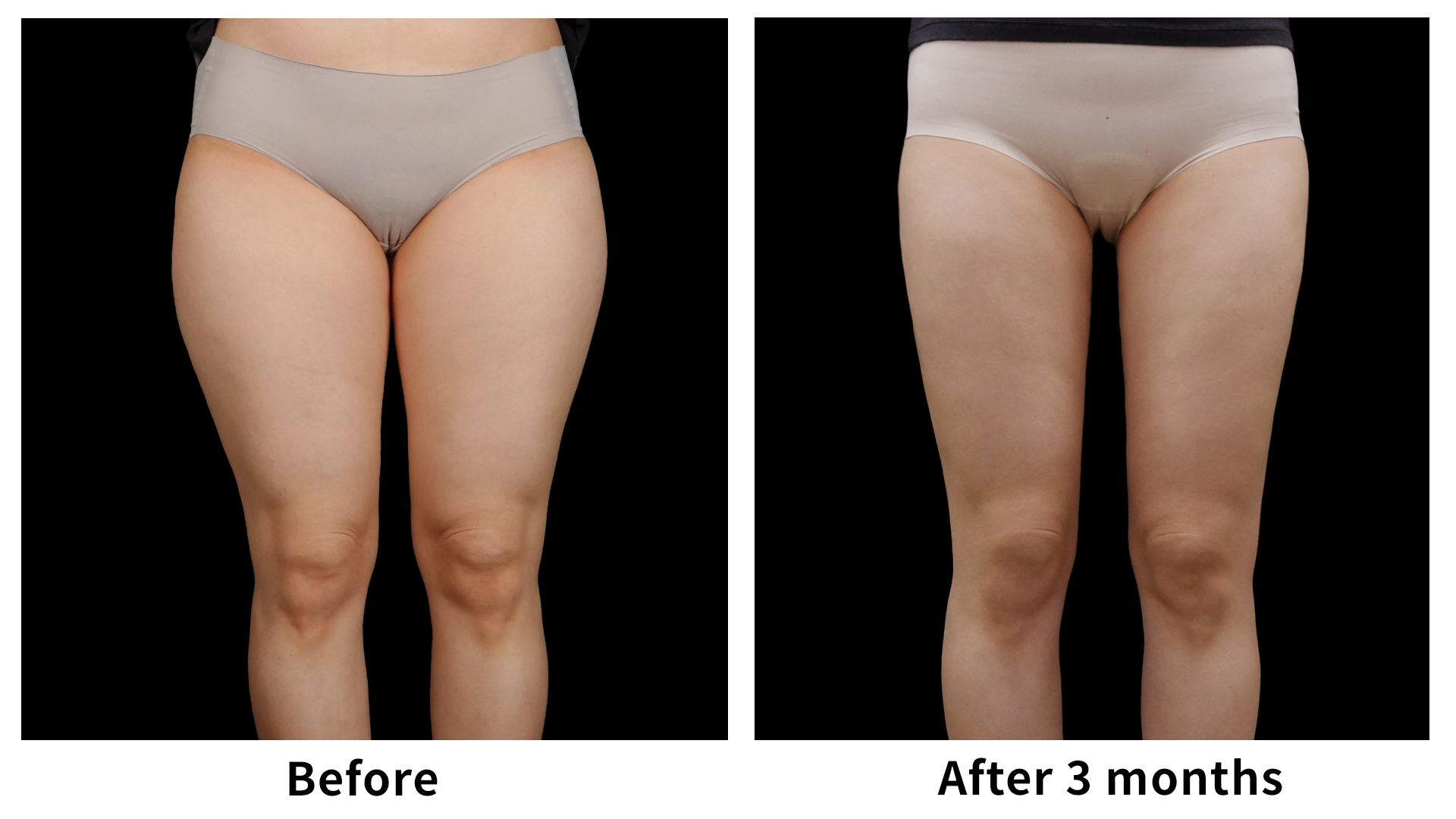 Meet Our Patients 62 Liposuction in South Korea