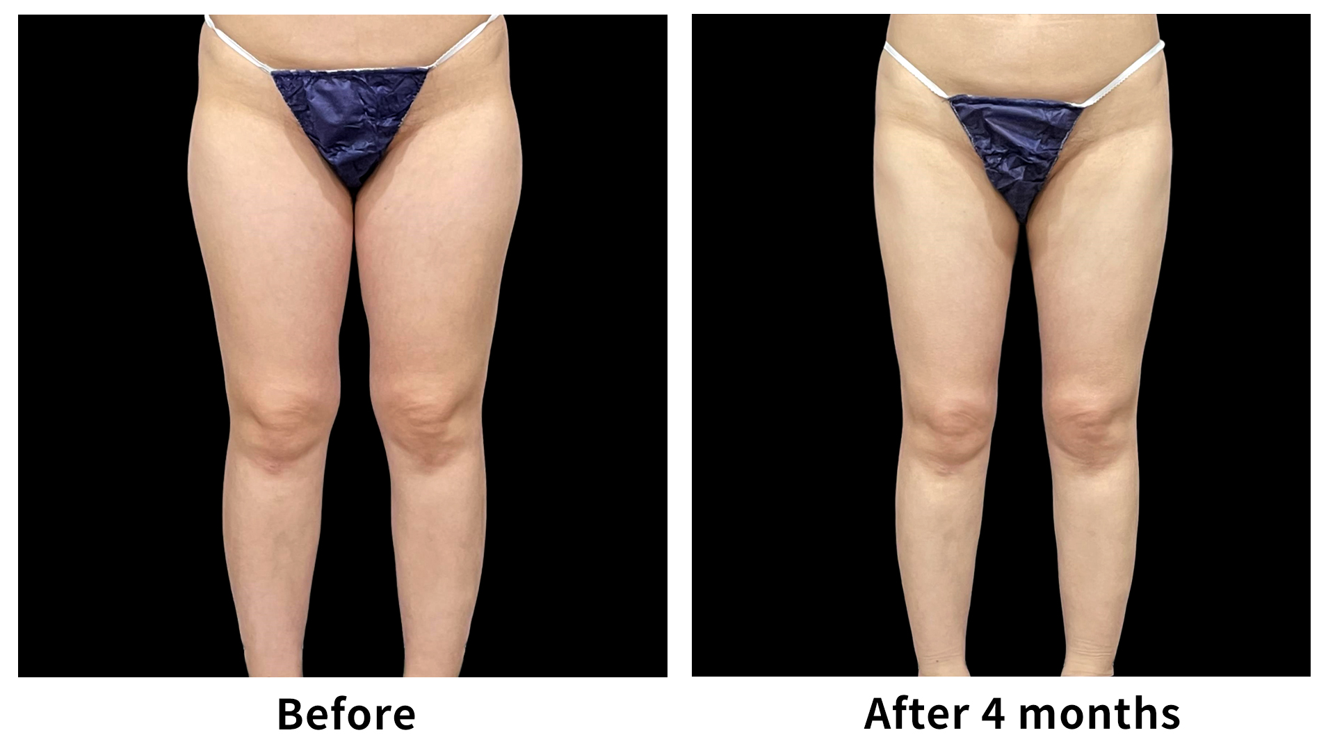 Meet Our Patients 64 Liposuction in South Korea