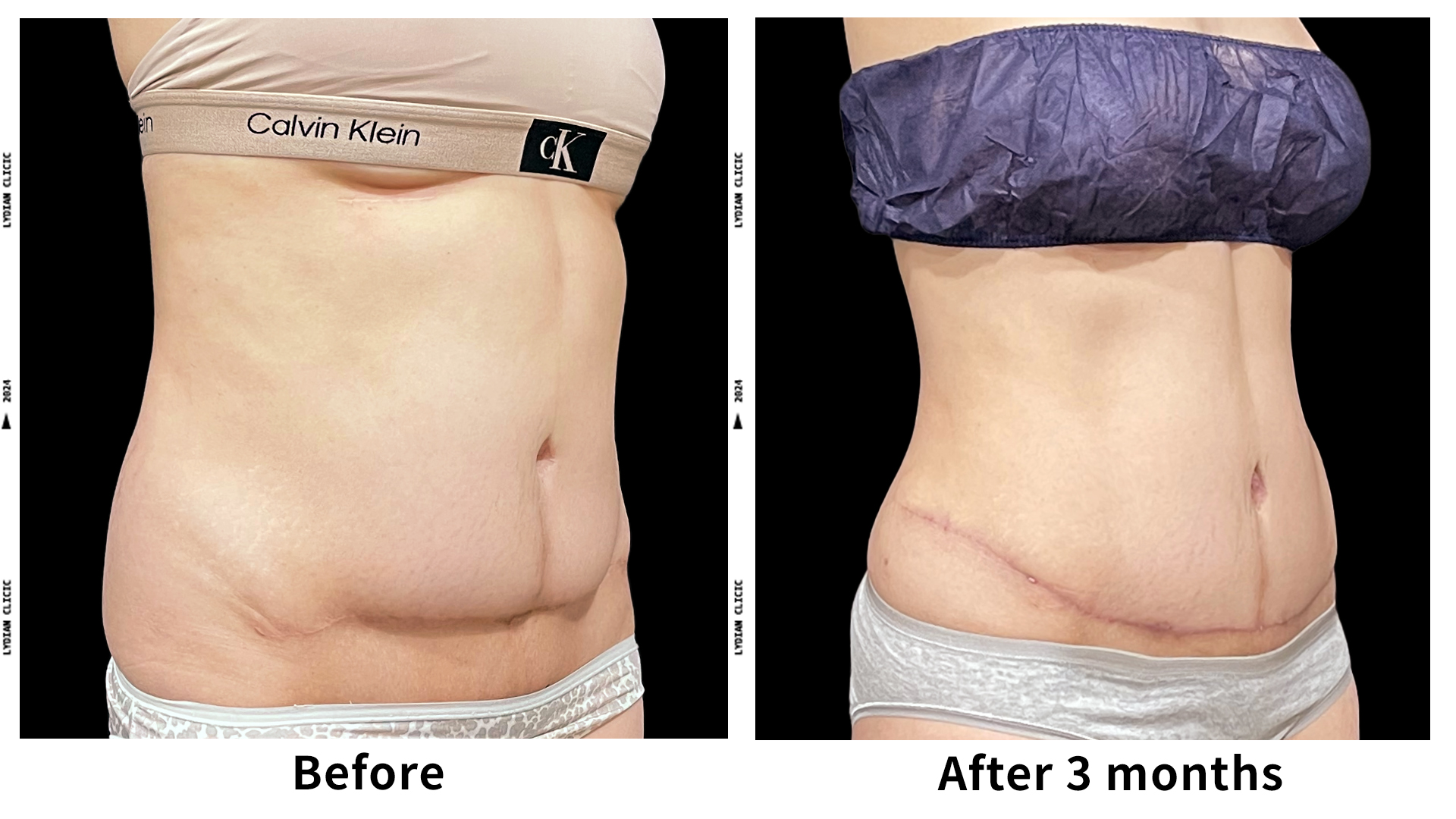 Meet Our Patients 55 Liposuction in South Korea