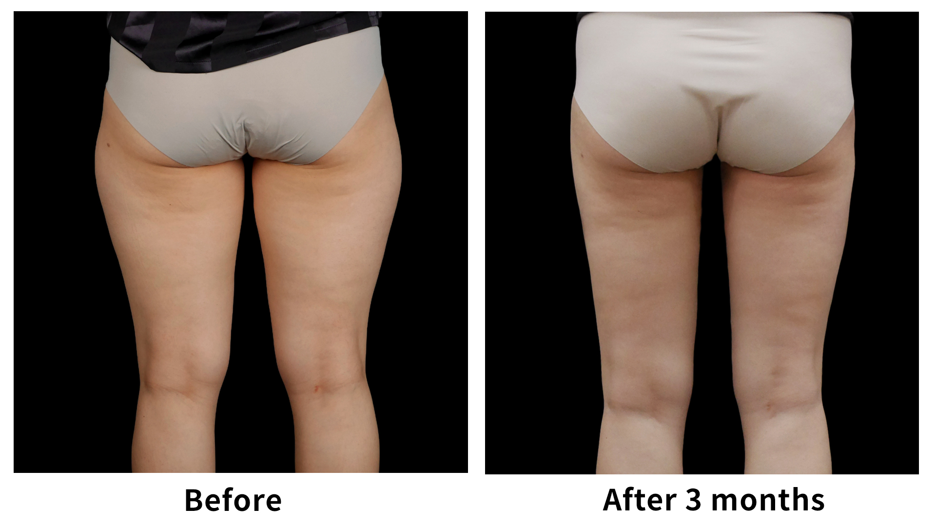 Meet Our Patients 61 Liposuction in South Korea