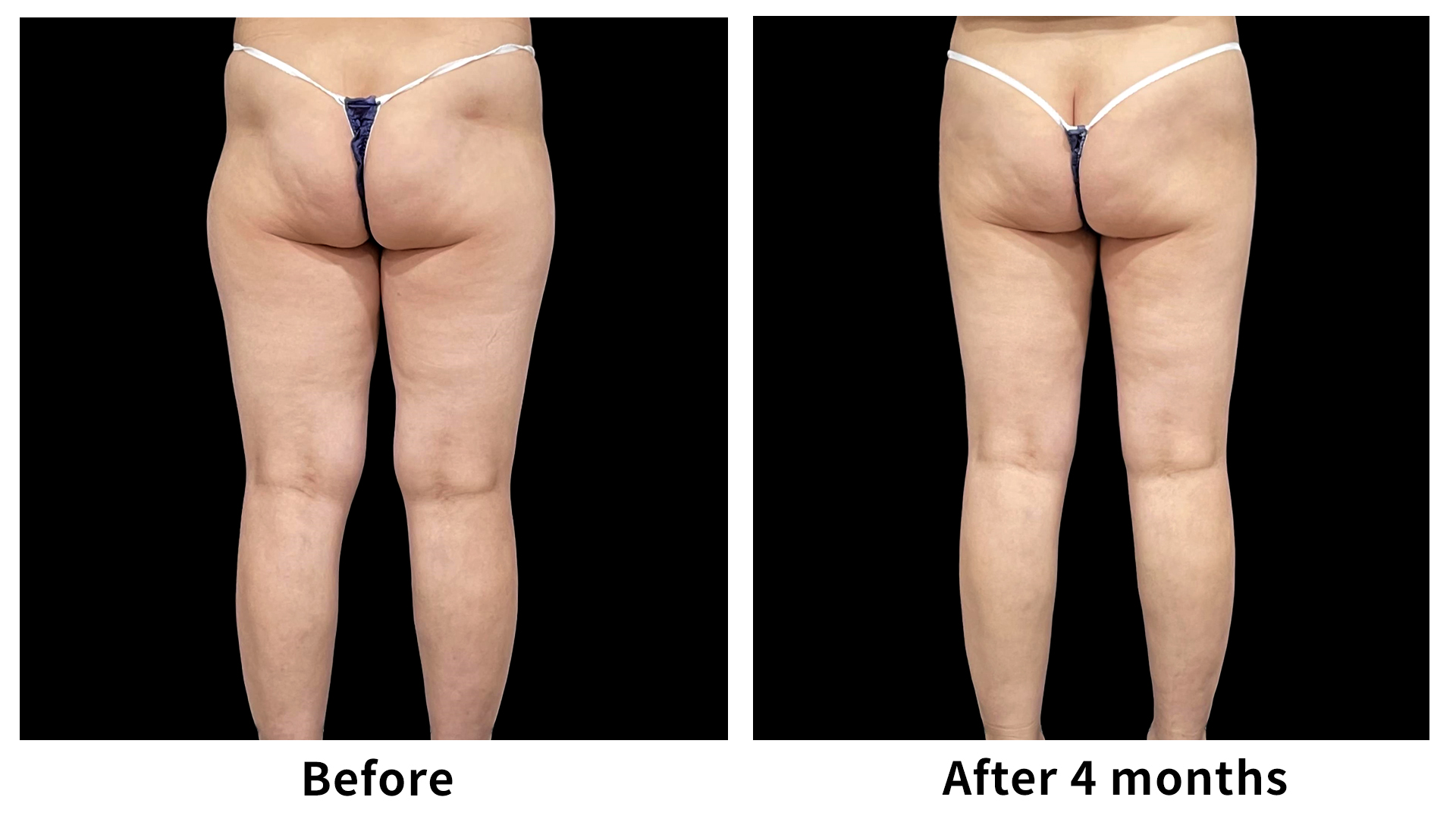 Meet Our Patients 63 Liposuction in South Korea