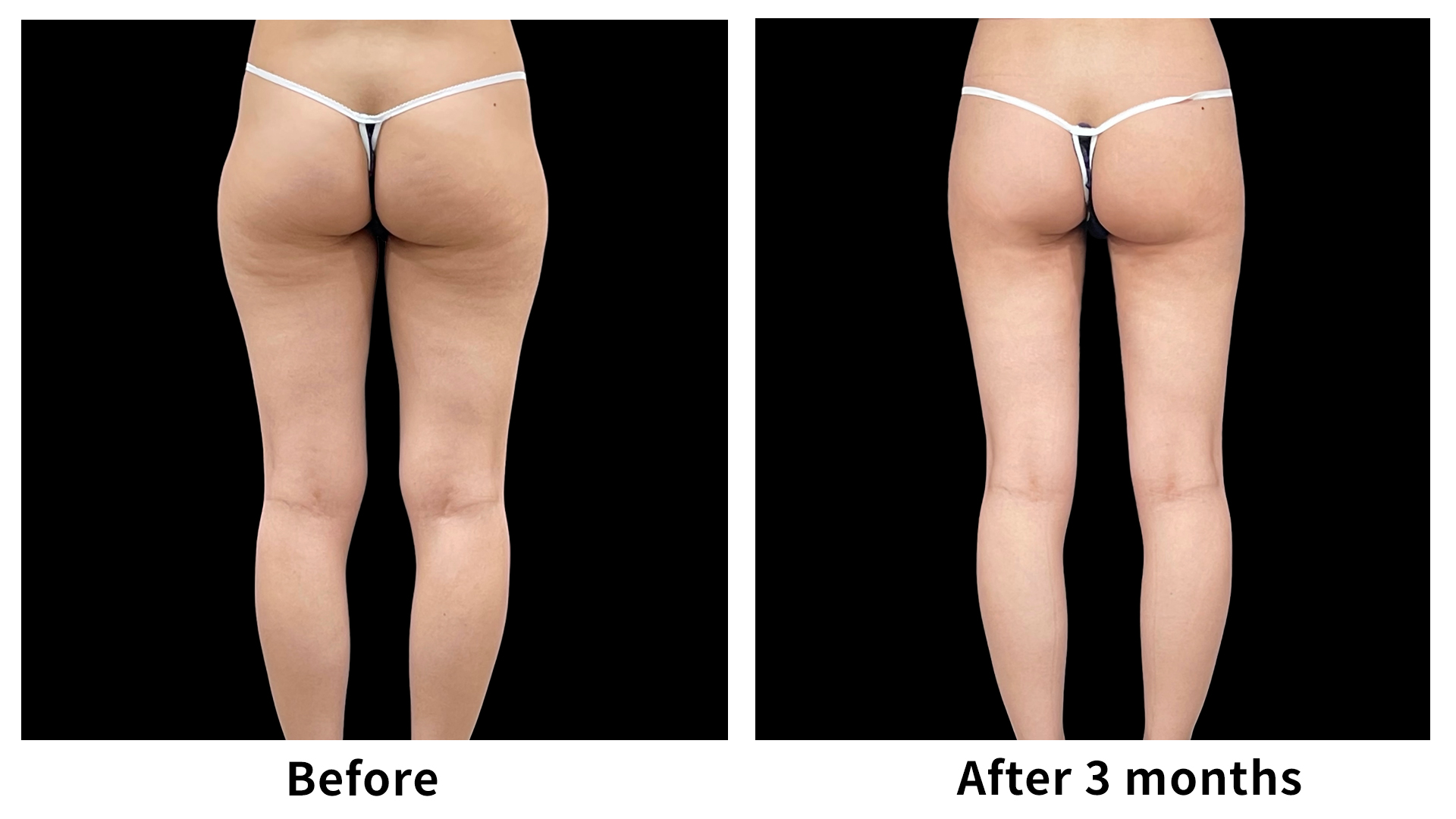 Meet Our Patients 100 Liposuction in South Korea(10)