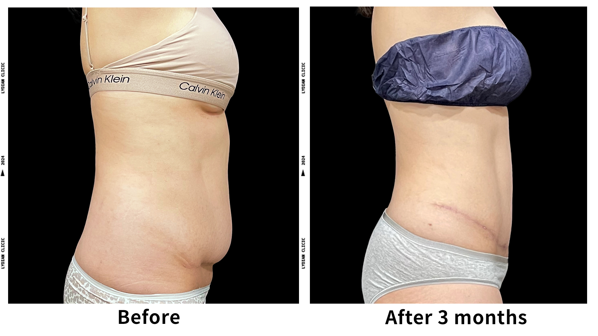 Meet Our Patients 56 Liposuction in South Korea