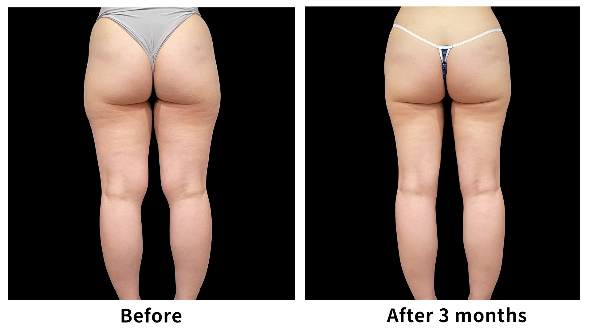 Meet Our Patients 94 Liposuction in South Korea(4)