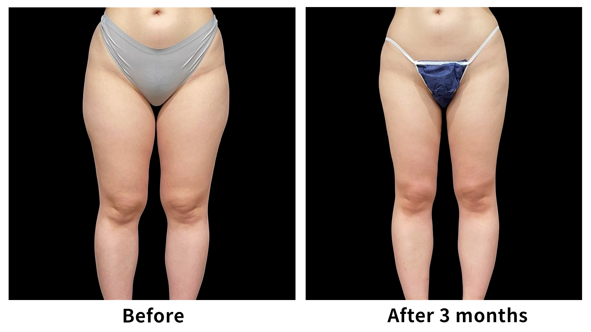 Meet Our Patients 95 Liposuction in South Korea(5)