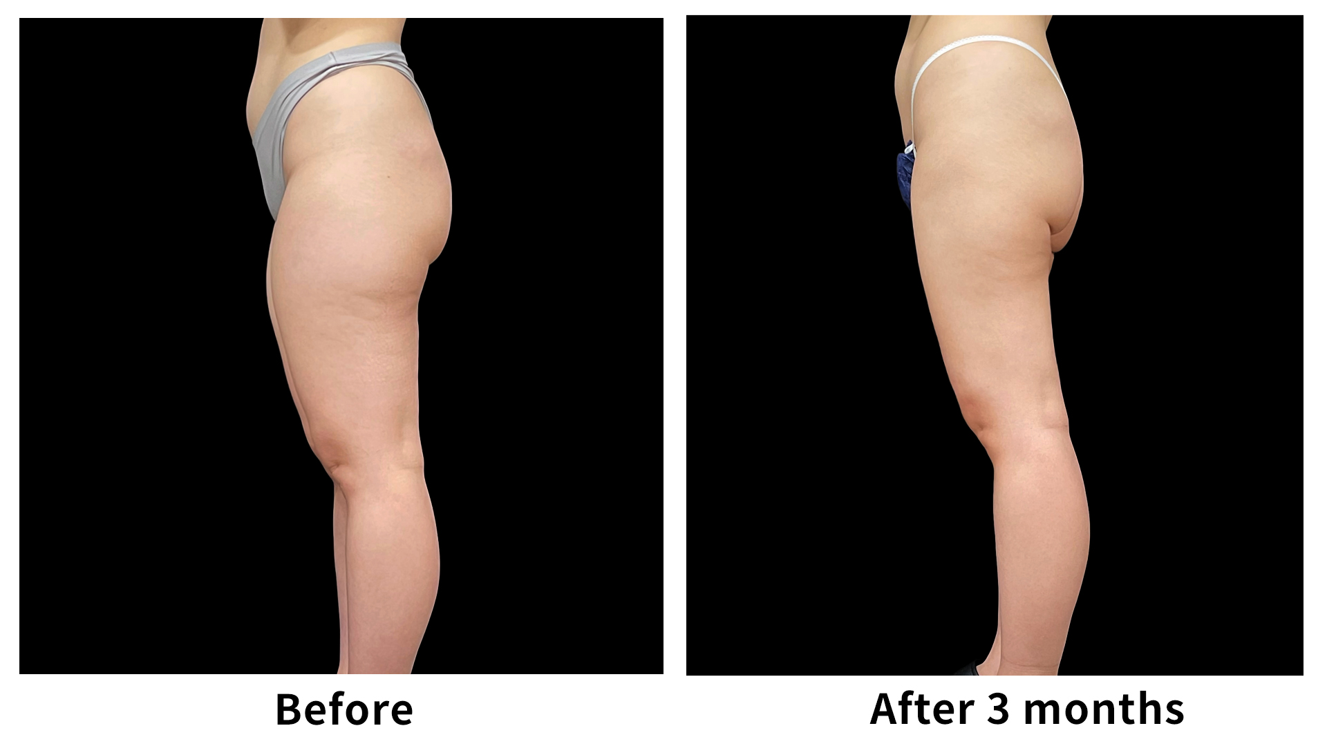 Meet Our Patients 96 Liposuction in South Korea(6)