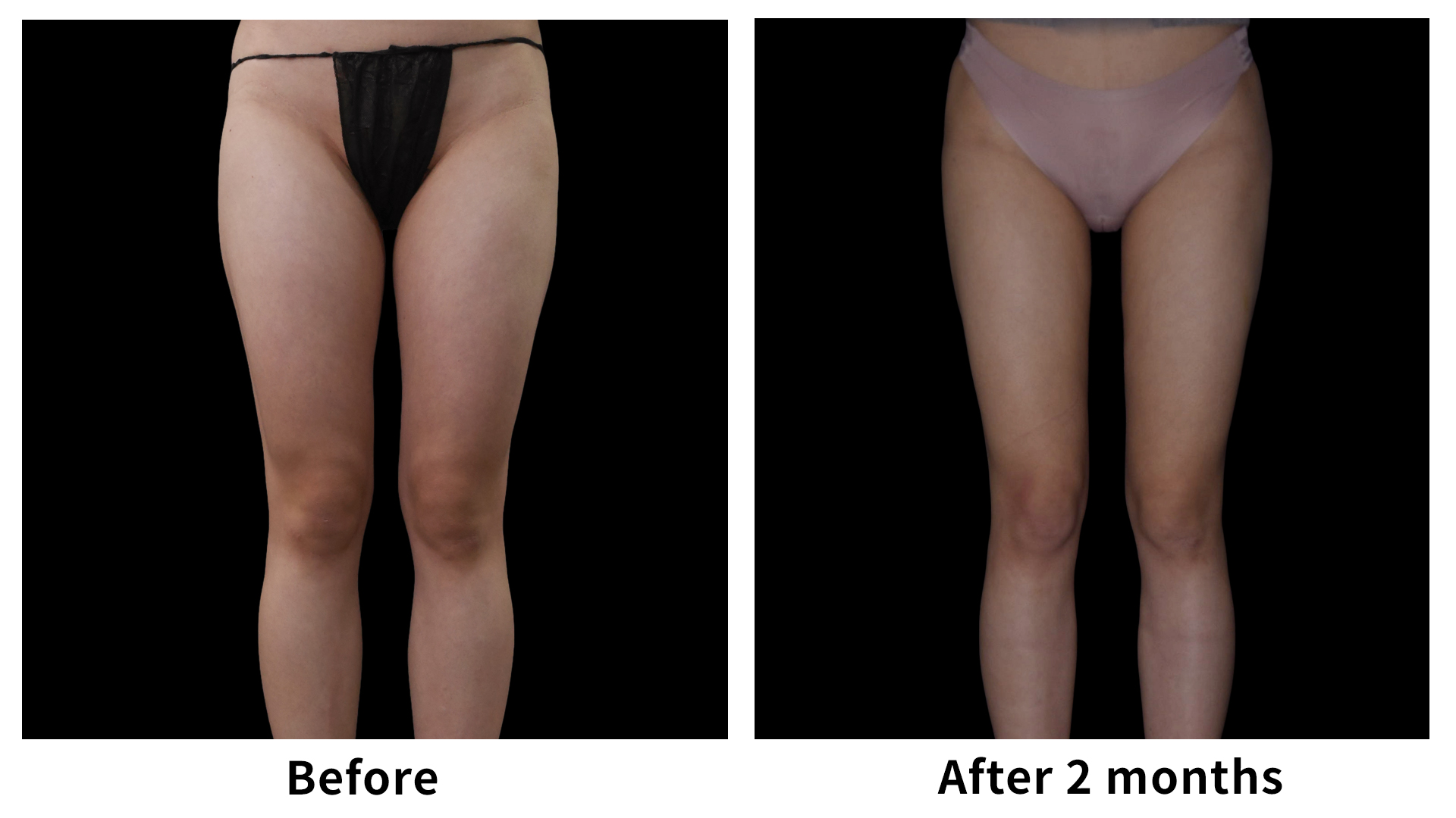 Meet Our Patients 97 Liposuction in South Korea(7)