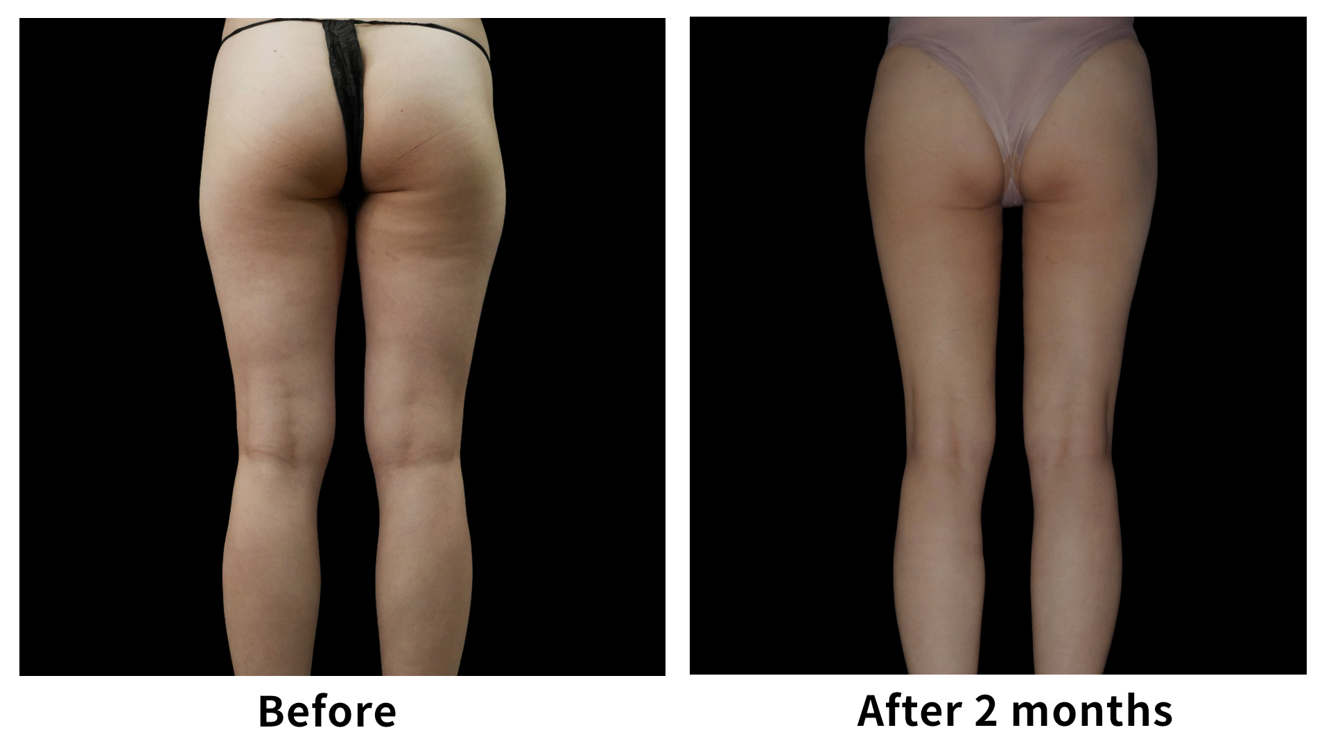 Meet Our Patients 98 Liposuction in South Korea(8)