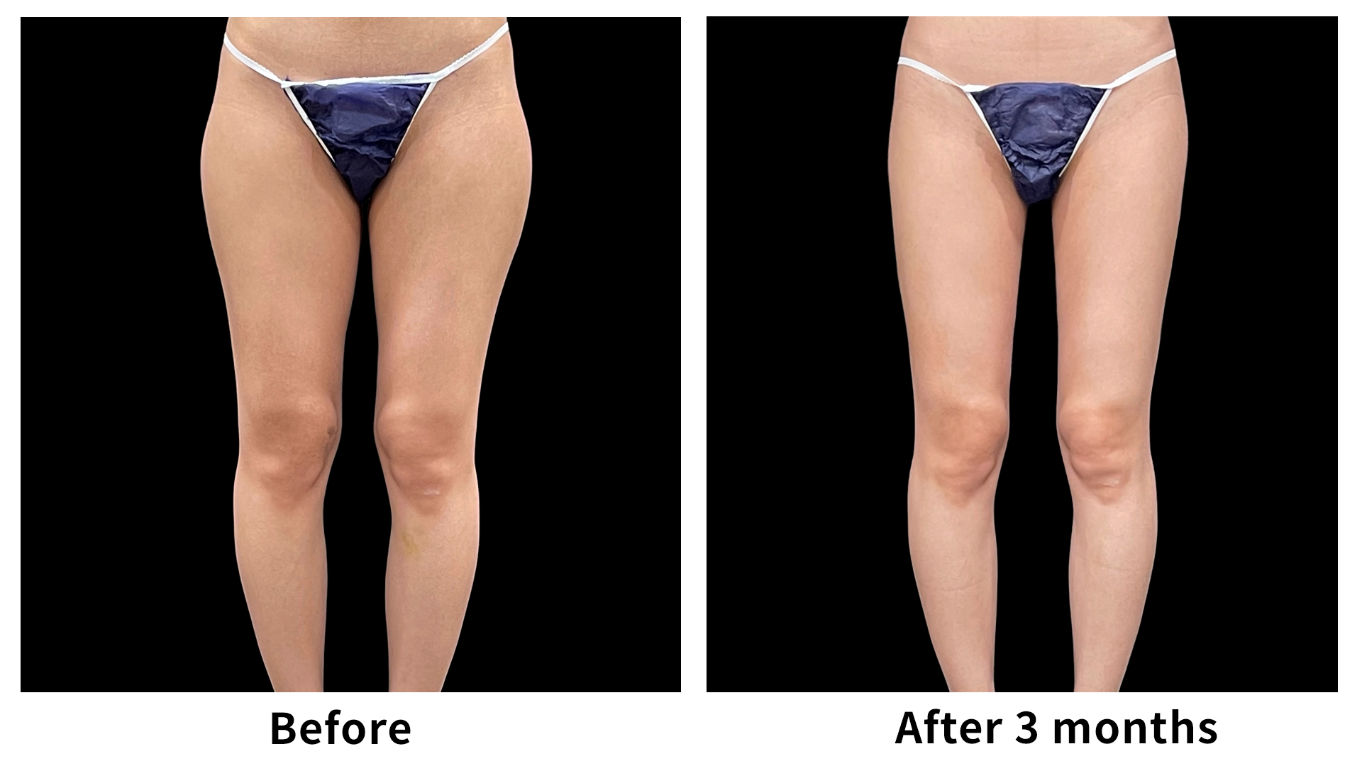 Meet Our Patients 99 Liposuction in South Korea(9)