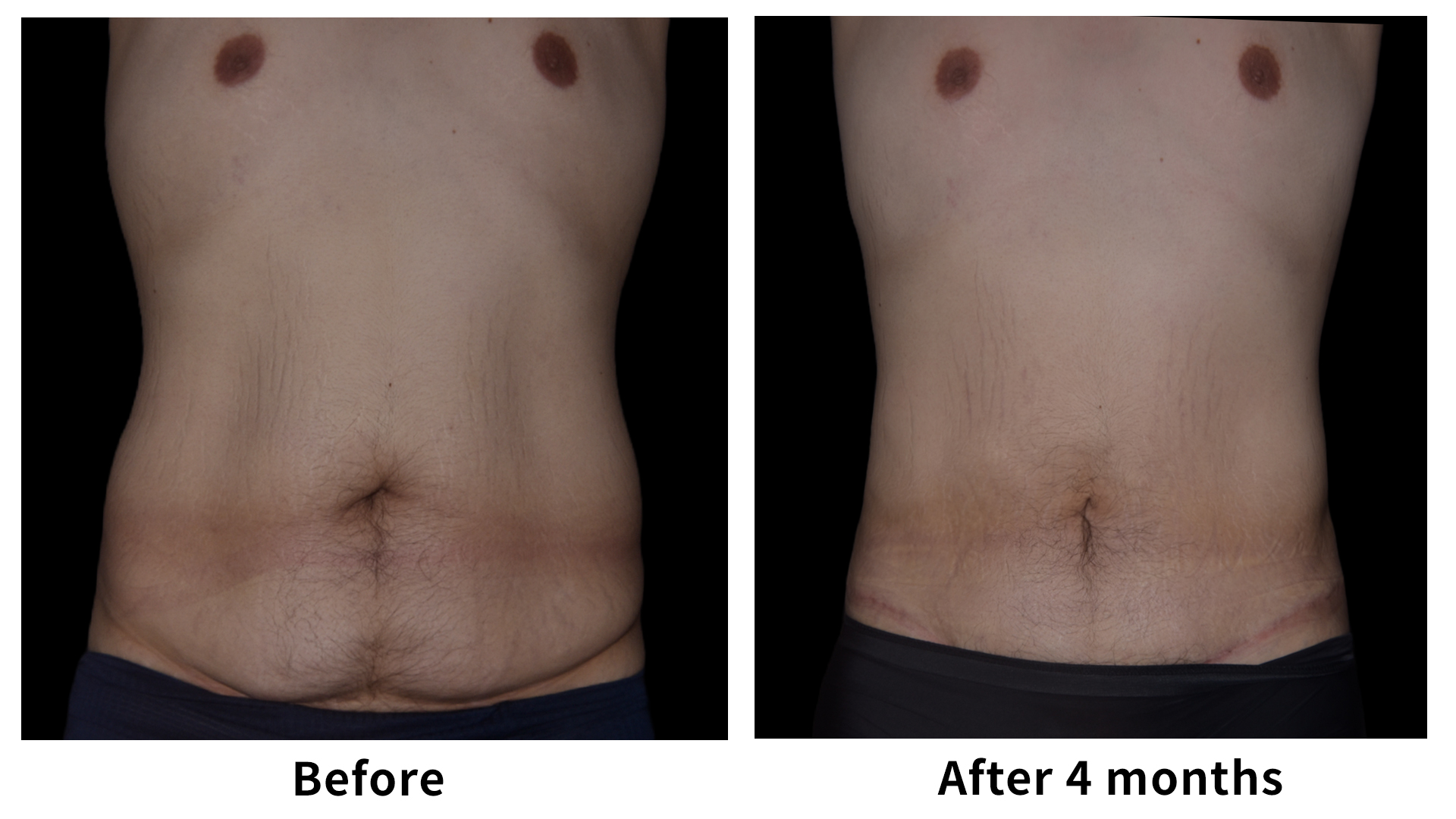 Meet Our Patients 60 Male Breast Reduction in South Korea