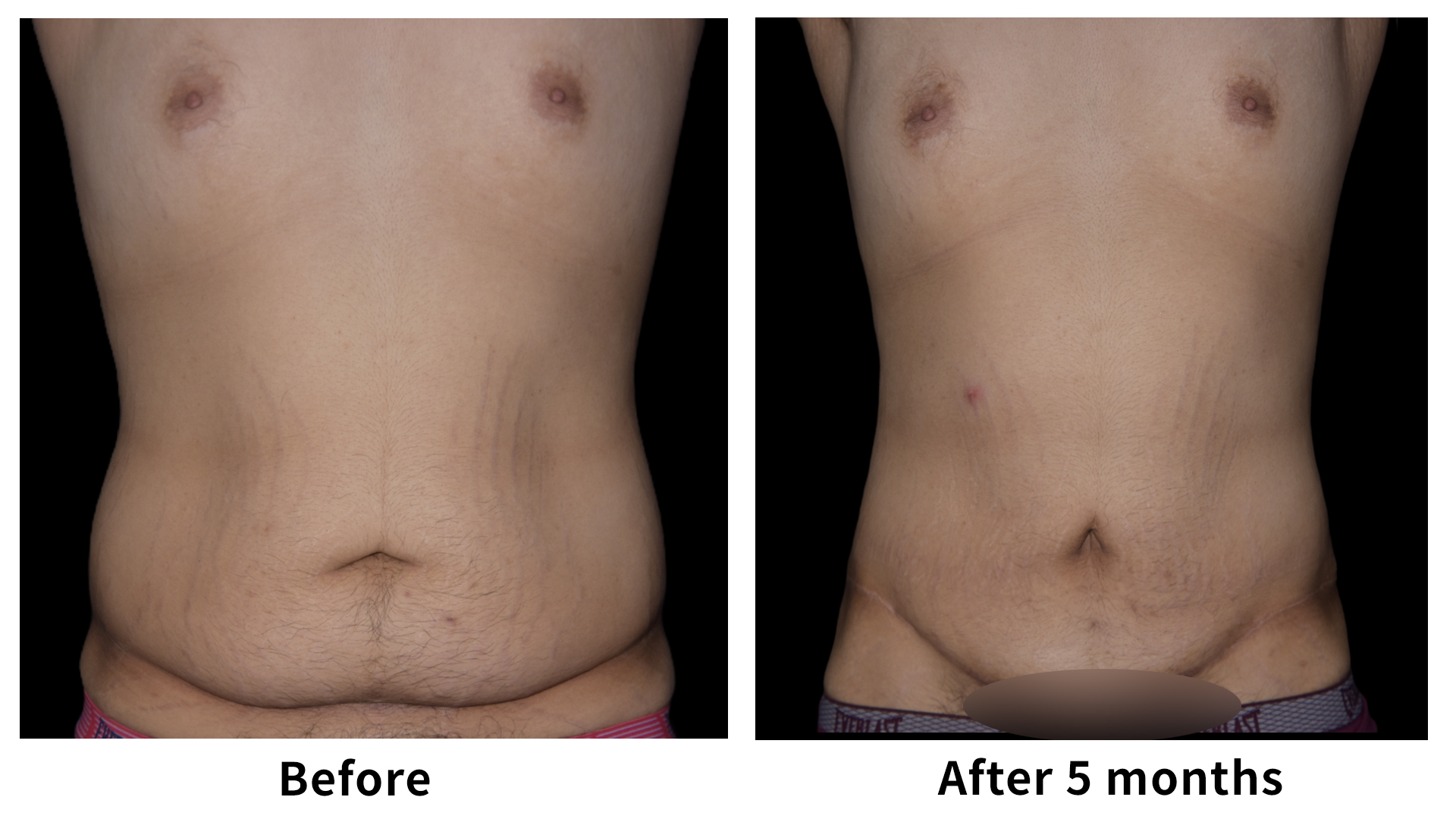 Meet Our Patients 102 Male Breast Reduction in South Korea(1)