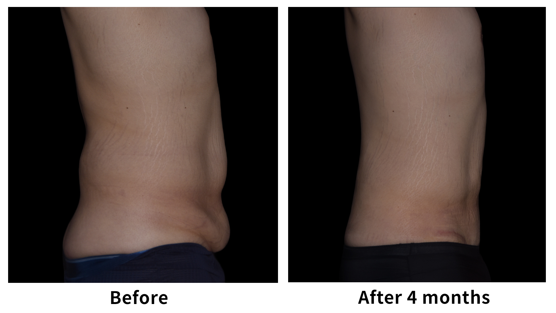 Meet Our Patients 59 Male Breast Reduction in South Korea