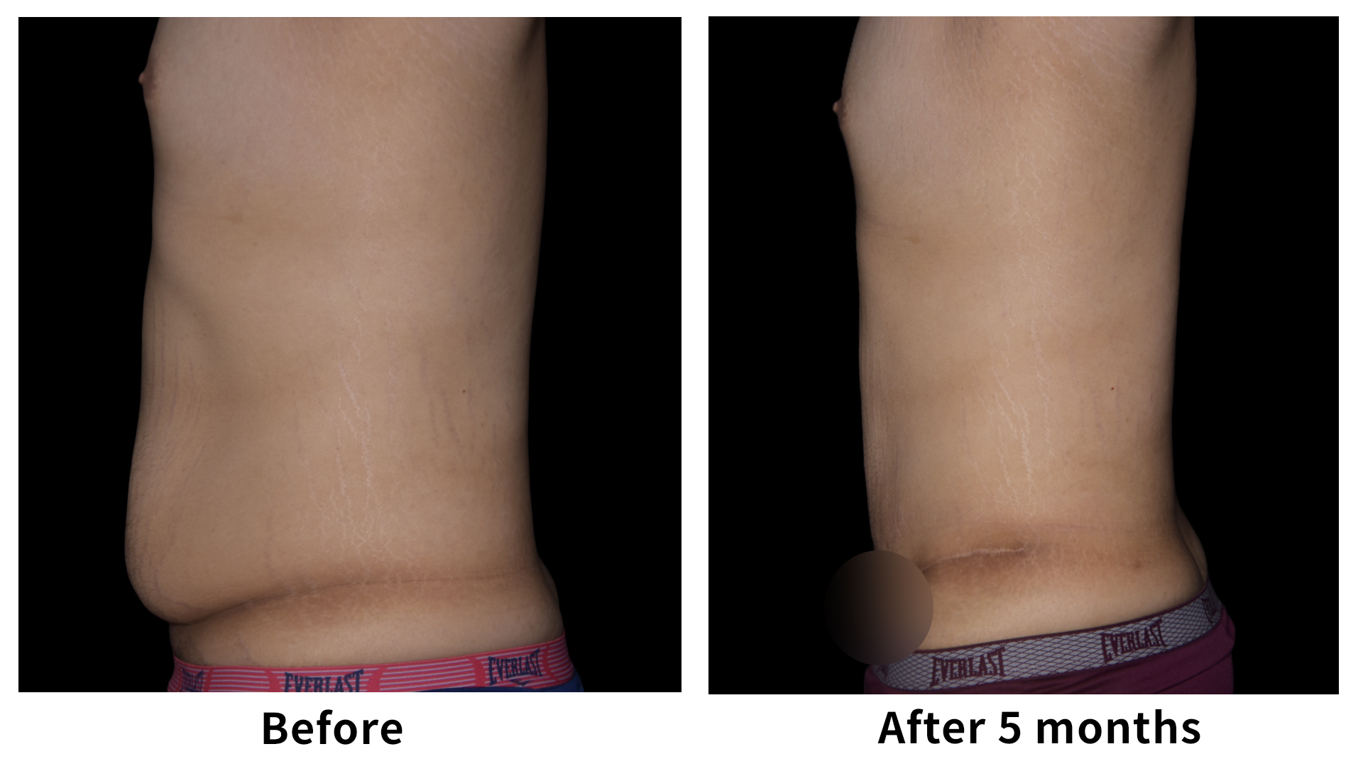 Meet Our Patients 103 Male Breast Reduction in South Korea(2)