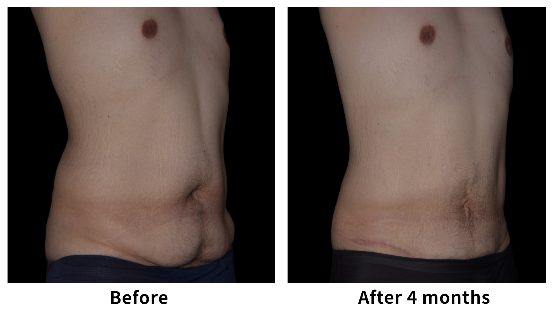 Meet Our Patients 104 Male Breast Reduction in South Korea(3)