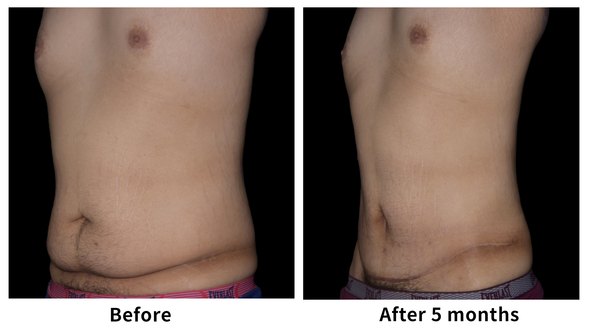 Meet Our Patients 105 Male Breast Reduction in South Korea(4)