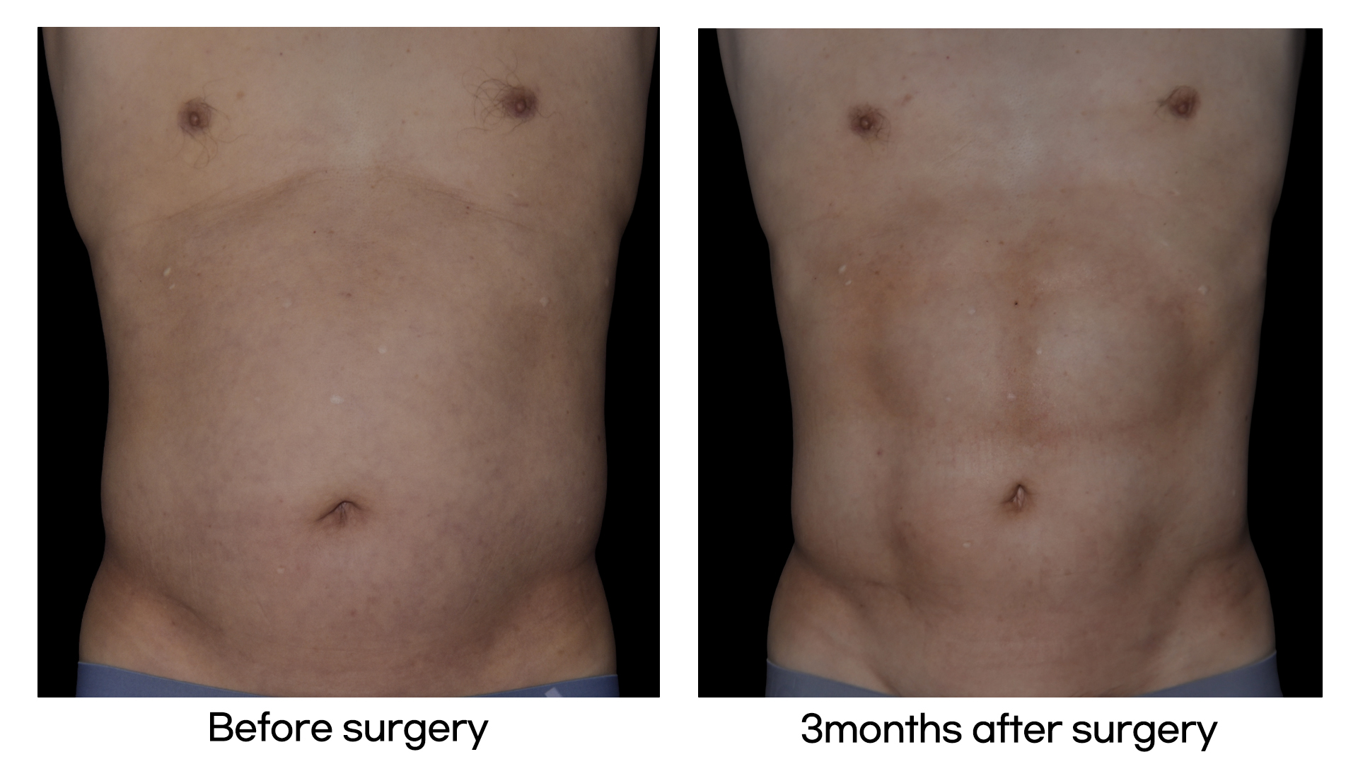 Meet Our Patients 47 Tummy Tuck in South Korea