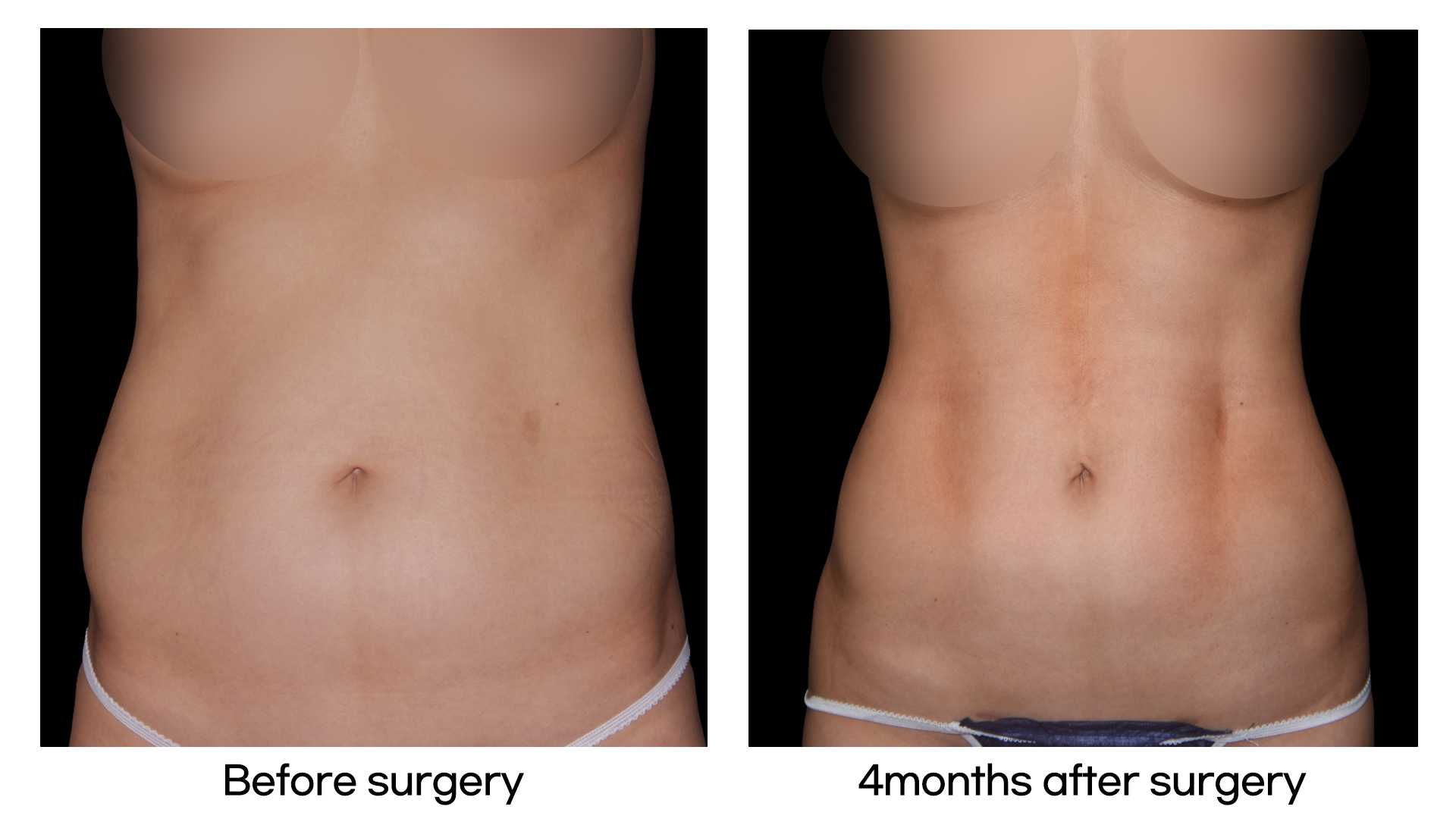 Meet Our Patients 49 Tummy Tuck in South Korea