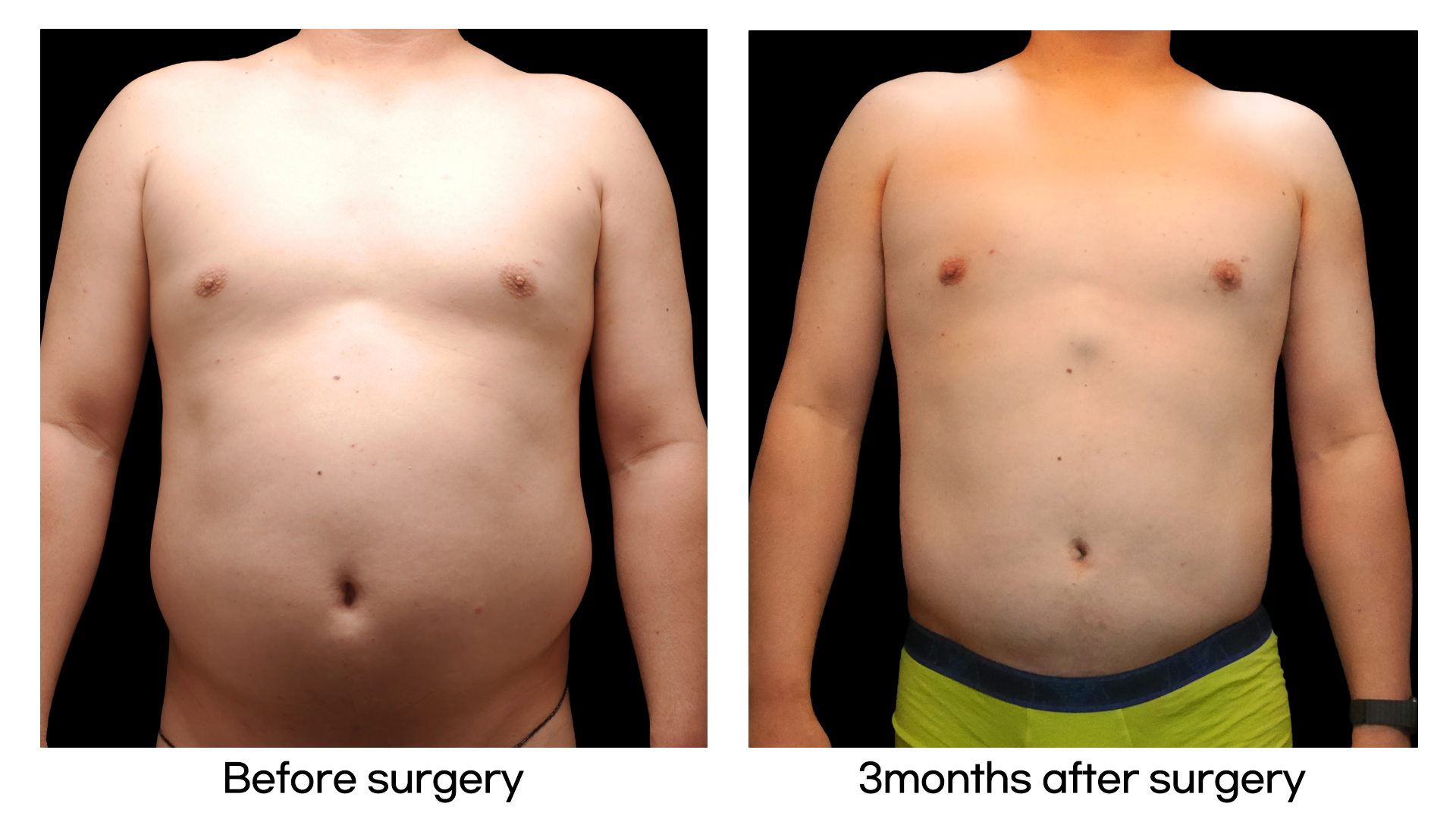 Meet Our Patients 109 Tummy Tuck in South Korea